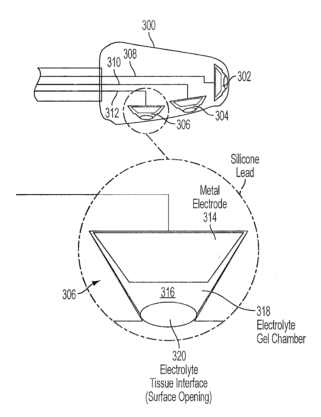 Implantable vestibular prosthesis