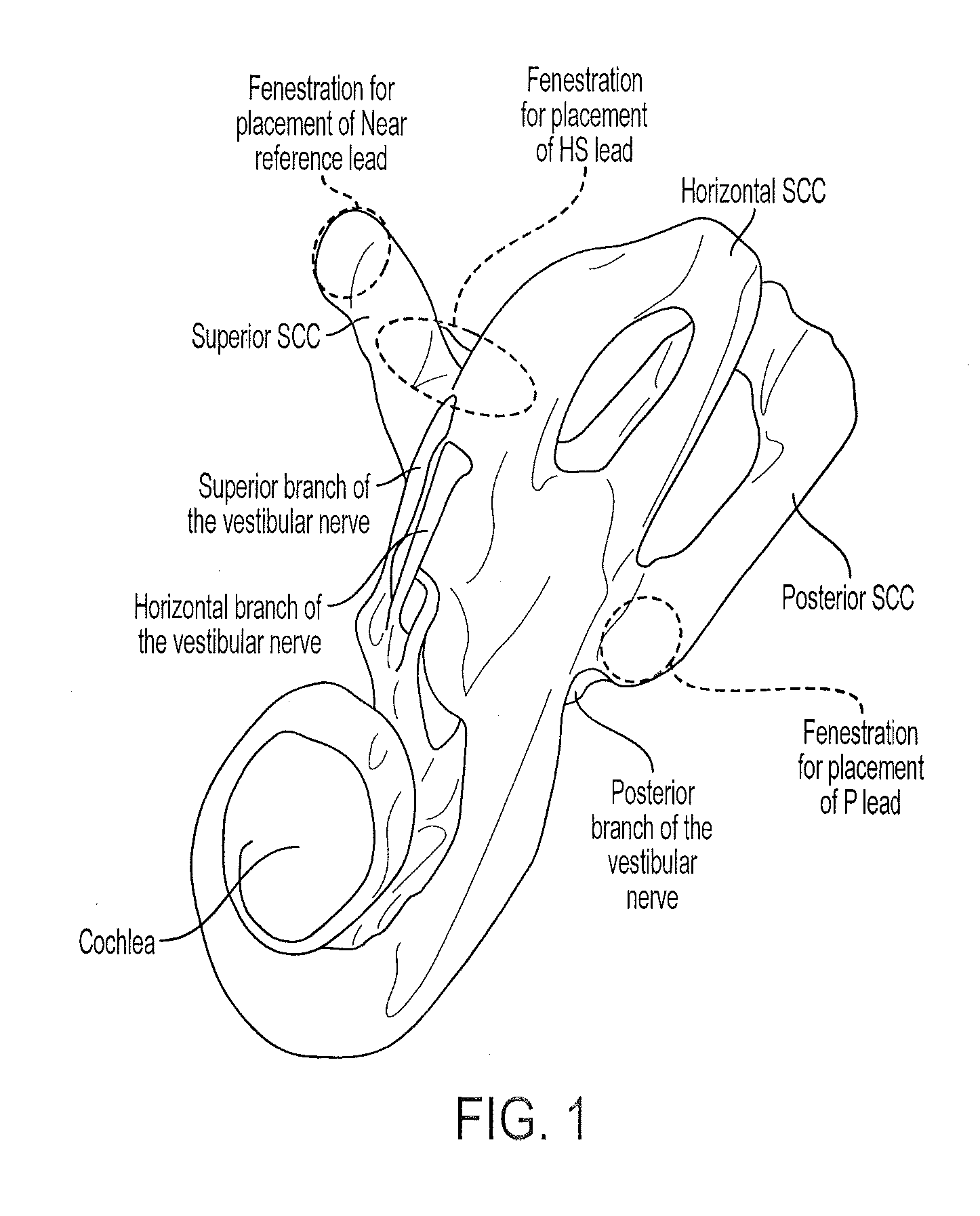 Implantable vestibular prosthesis