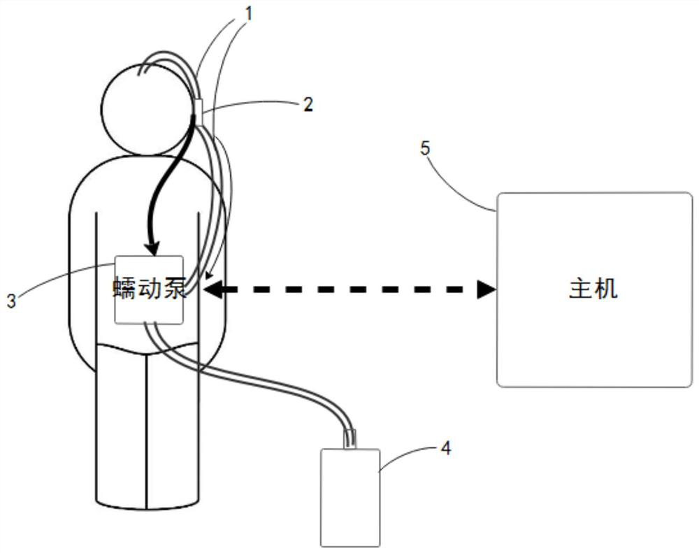 A portable cerebrospinal fluid diversion device