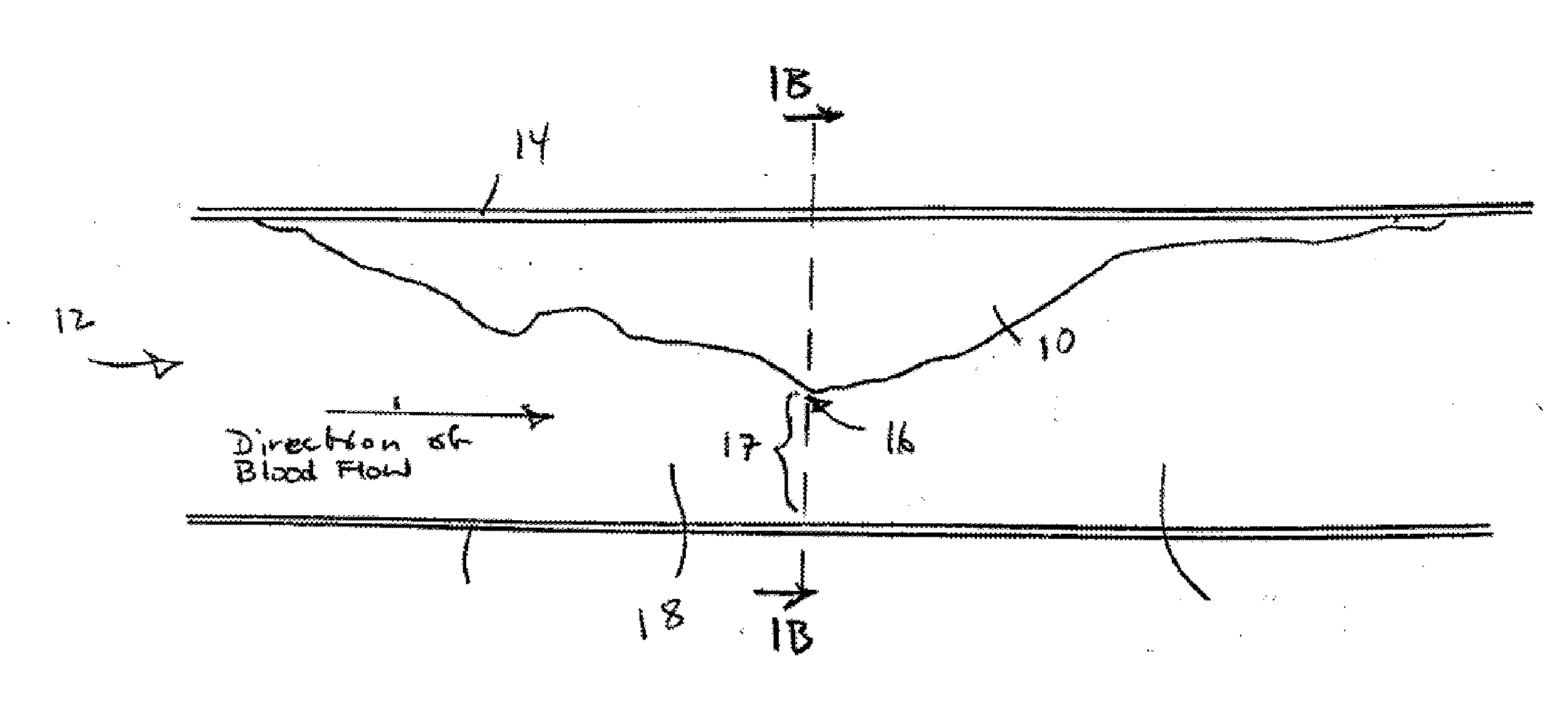 Method for determining shear stress and viscosity distribution in a blood vessel