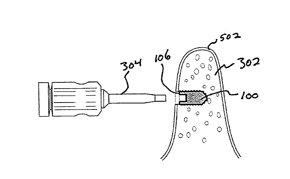 Implant Tack and Methods of Use Thereof