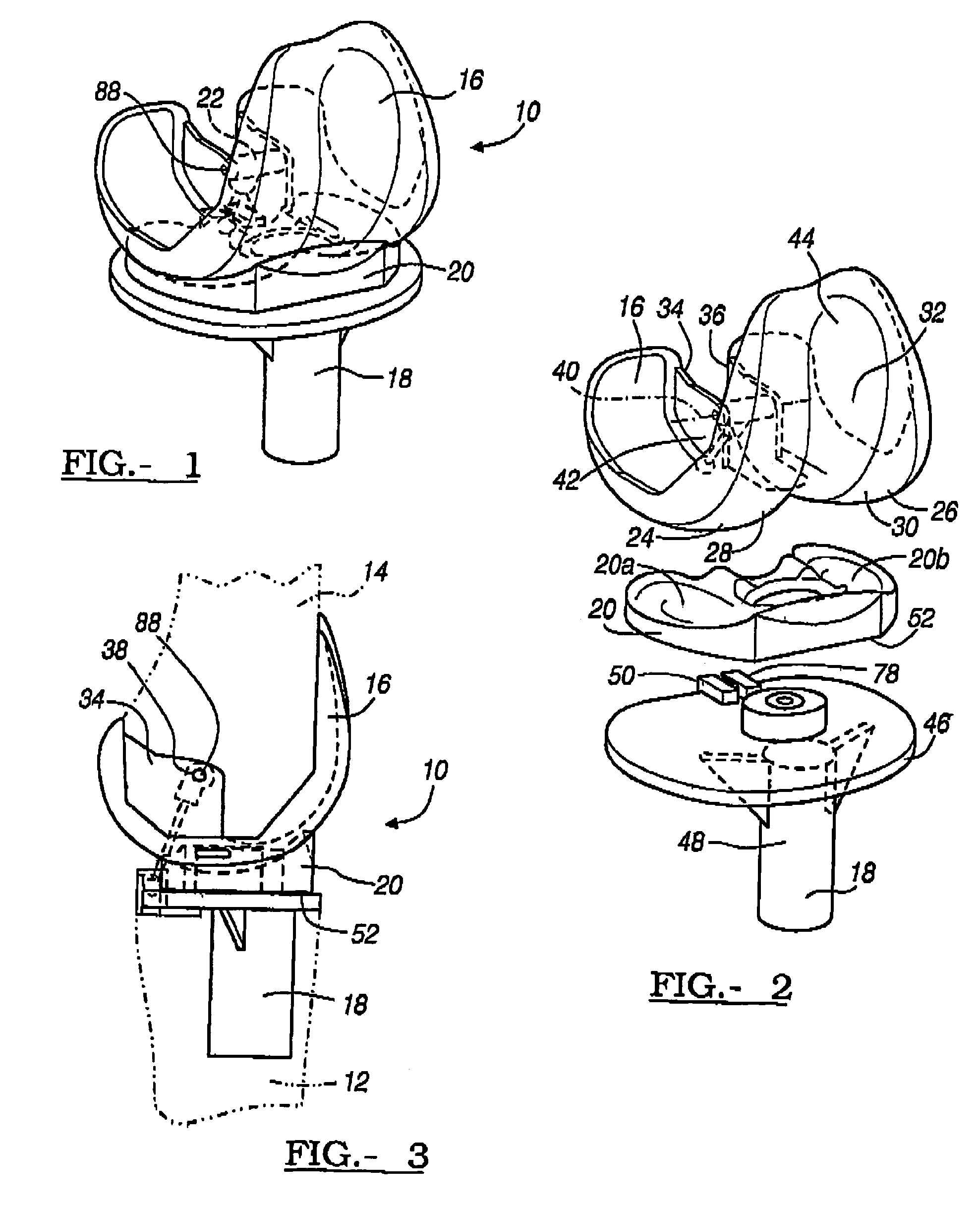 Method and apparatus for mechanically reconstructing ligaments in a knee prosthesis