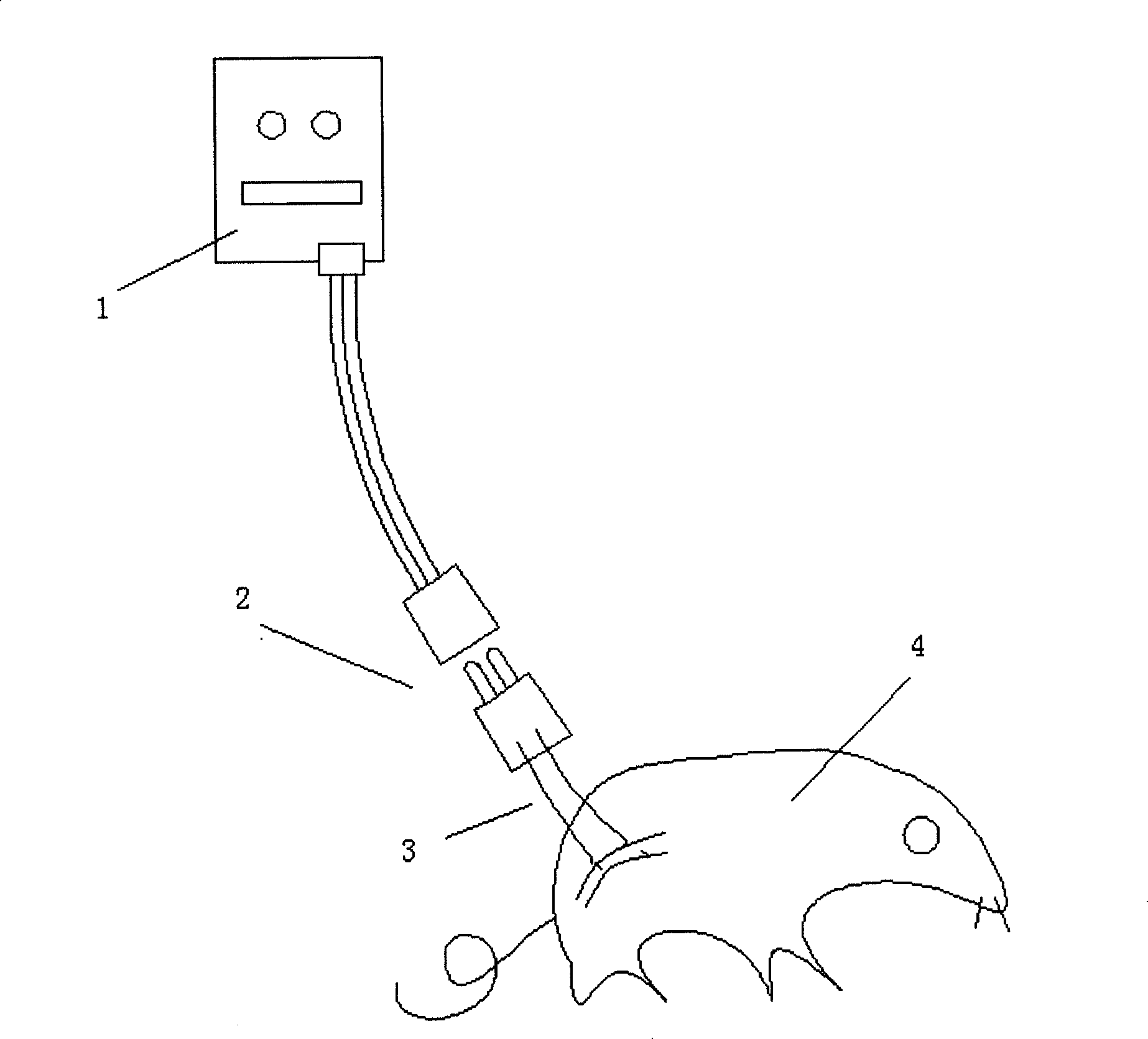 Application of east-to-take-out peripheral nerve semi-implantation type electric stimulation system