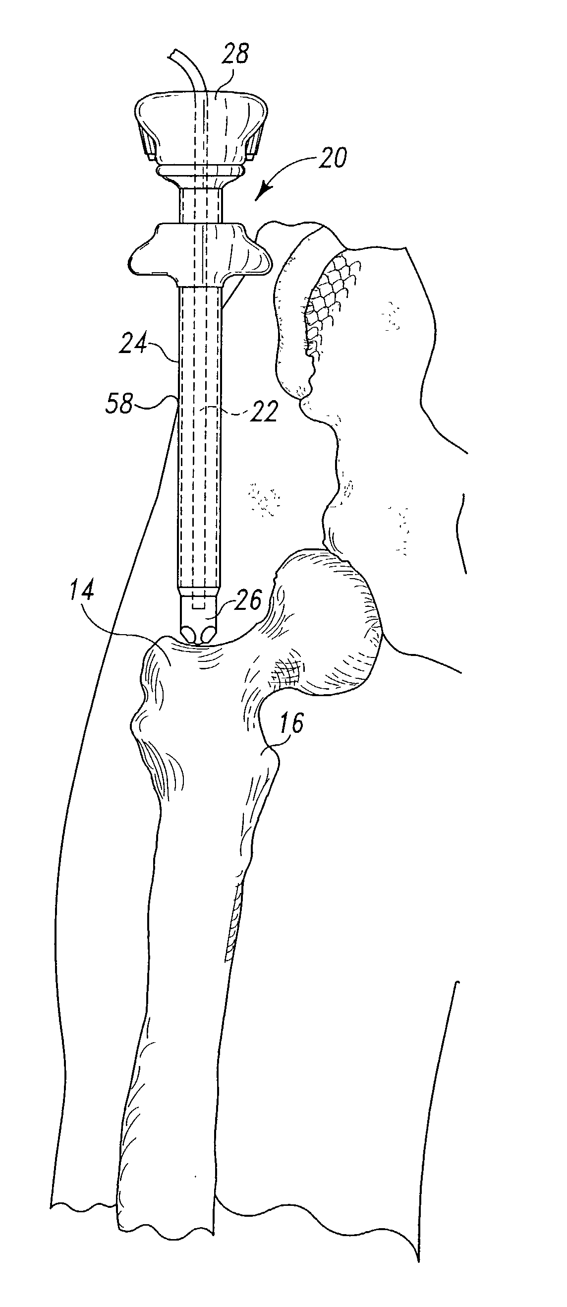 Method and apparatus for use in the performance of endoscopic minimally invasive orthopaedic plating procedures
