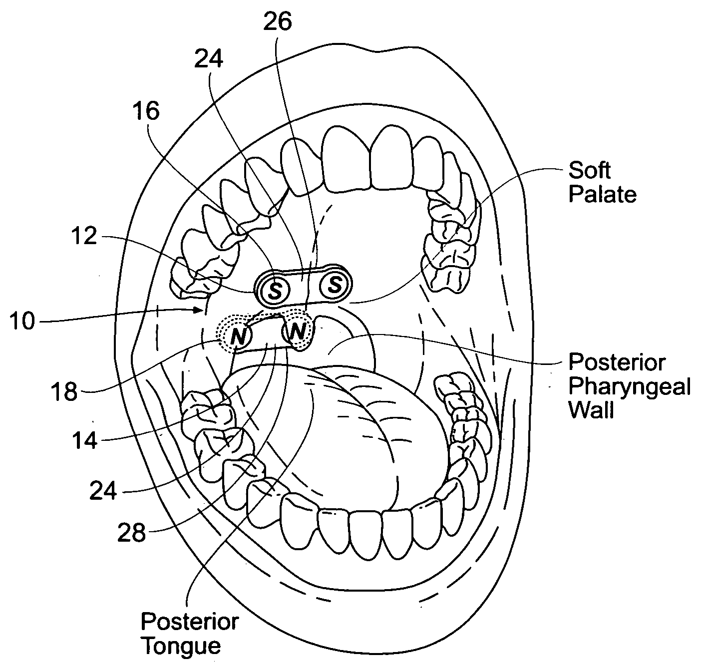 Devices, systems, and methods using magnetic force systems in or on soft palate tissue