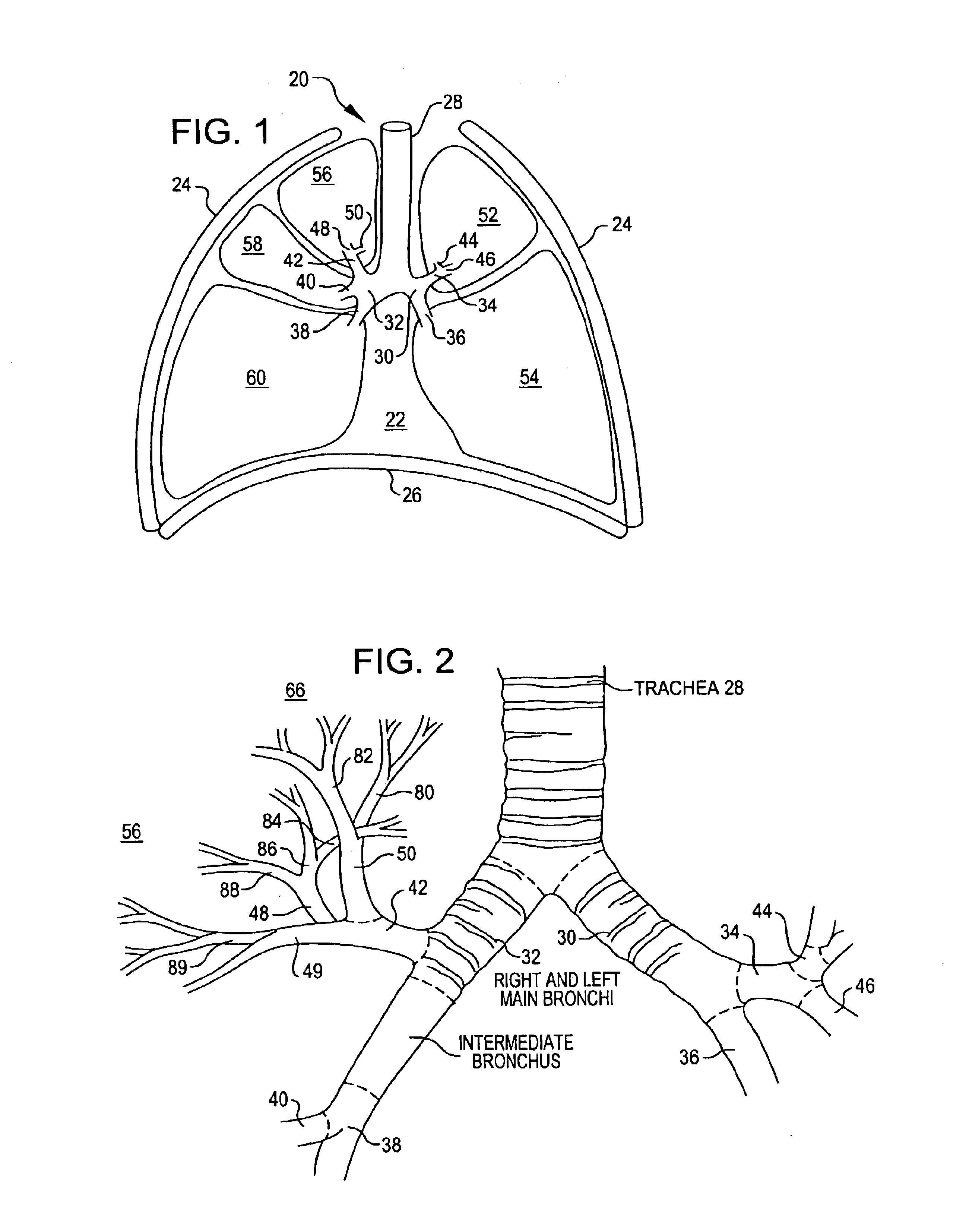 Device and method for intra-bronchial provision of a therapeutic agent