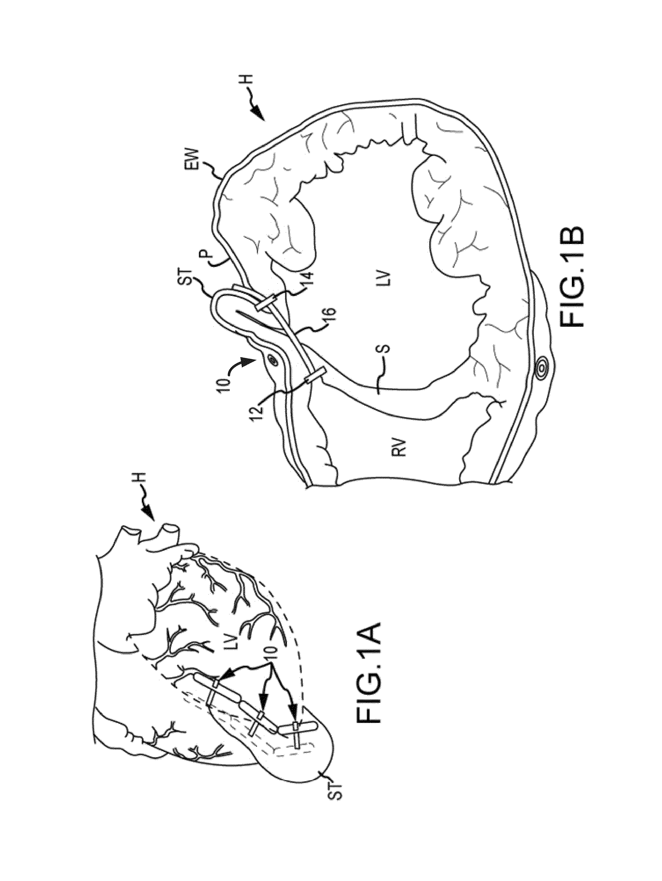 Trans-catheter ventricular reconstruction structures, methods, and systems for treatment of congestive heart failure and other conditions