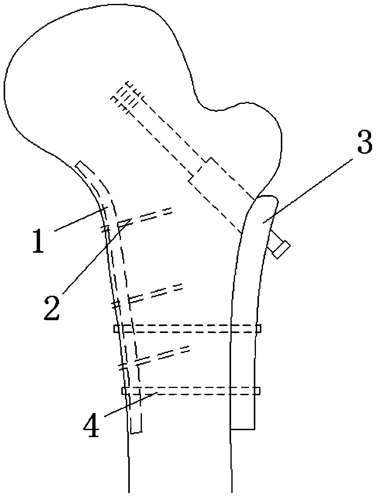 Inside support structure for medullary cavity suitable for strengthening internal fixation for proximal femoral fracture