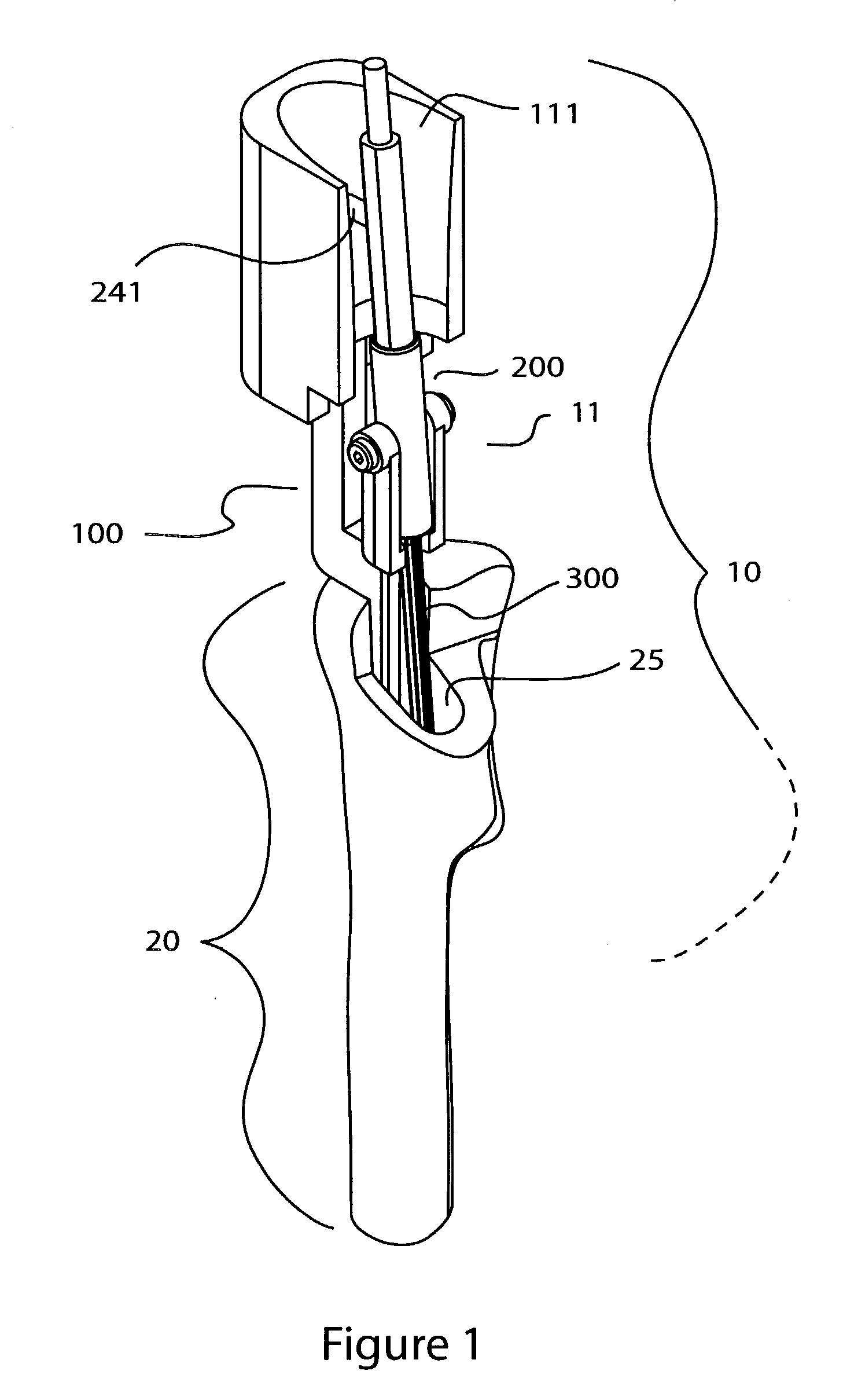 Surgical milling instrument for shaping a bone cavity