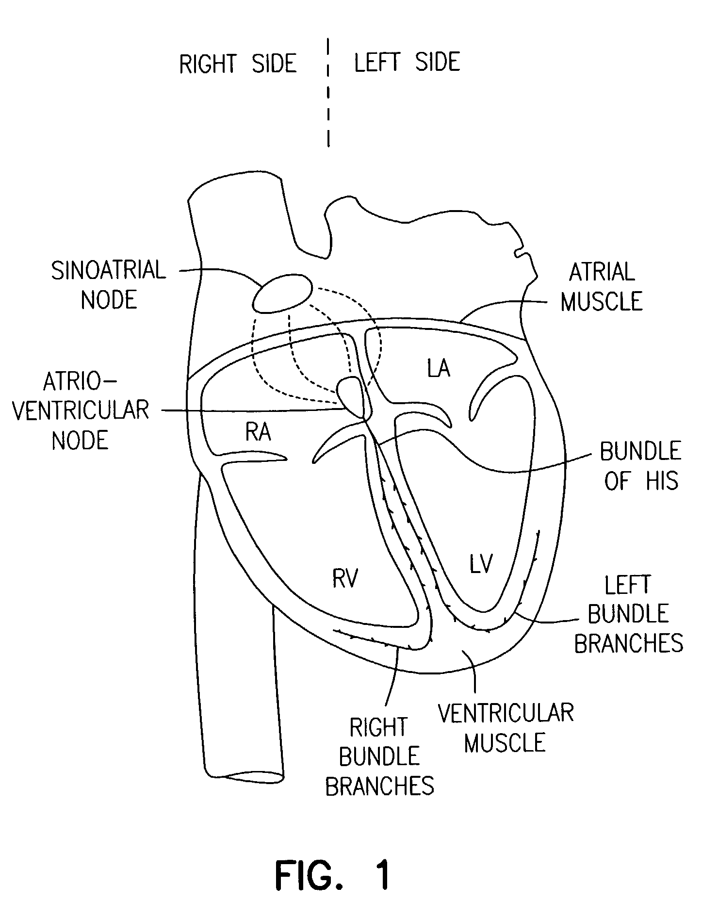Method and apparatus for optimizing stroke volume during DDD resynchronization therapy using adjustable atrio-ventricular delays