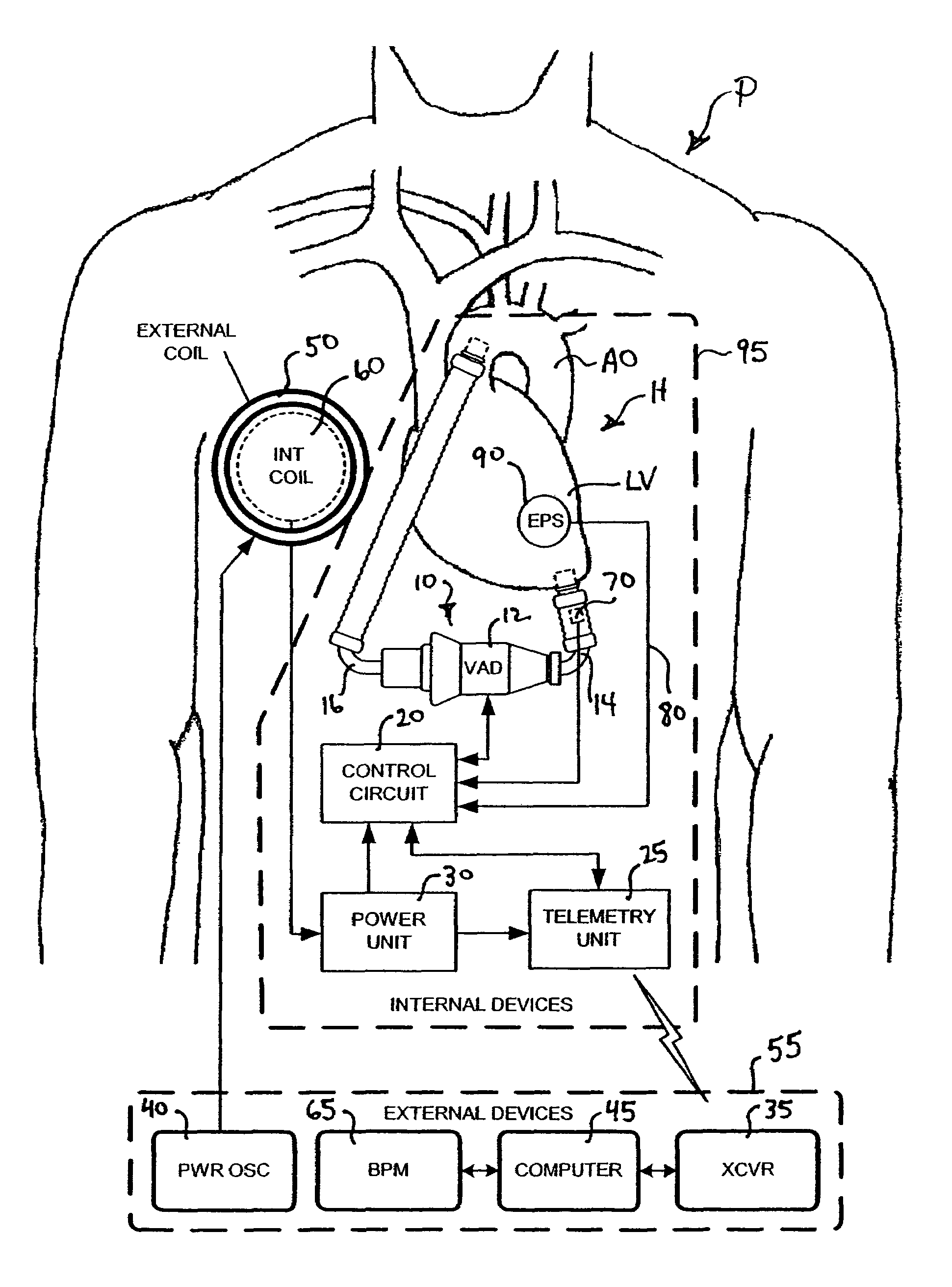 Feedback control and ventricular assist devices