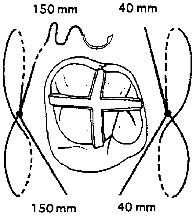 Method for autogenous transplantation of human and animal teeth that eliminates the risk of ankylosis and root resorption