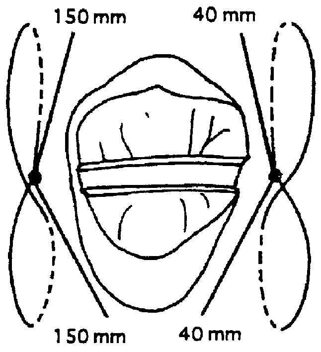 Method for autogenous transplantation of human and animal teeth that eliminates the risk of ankylosis and root resorption