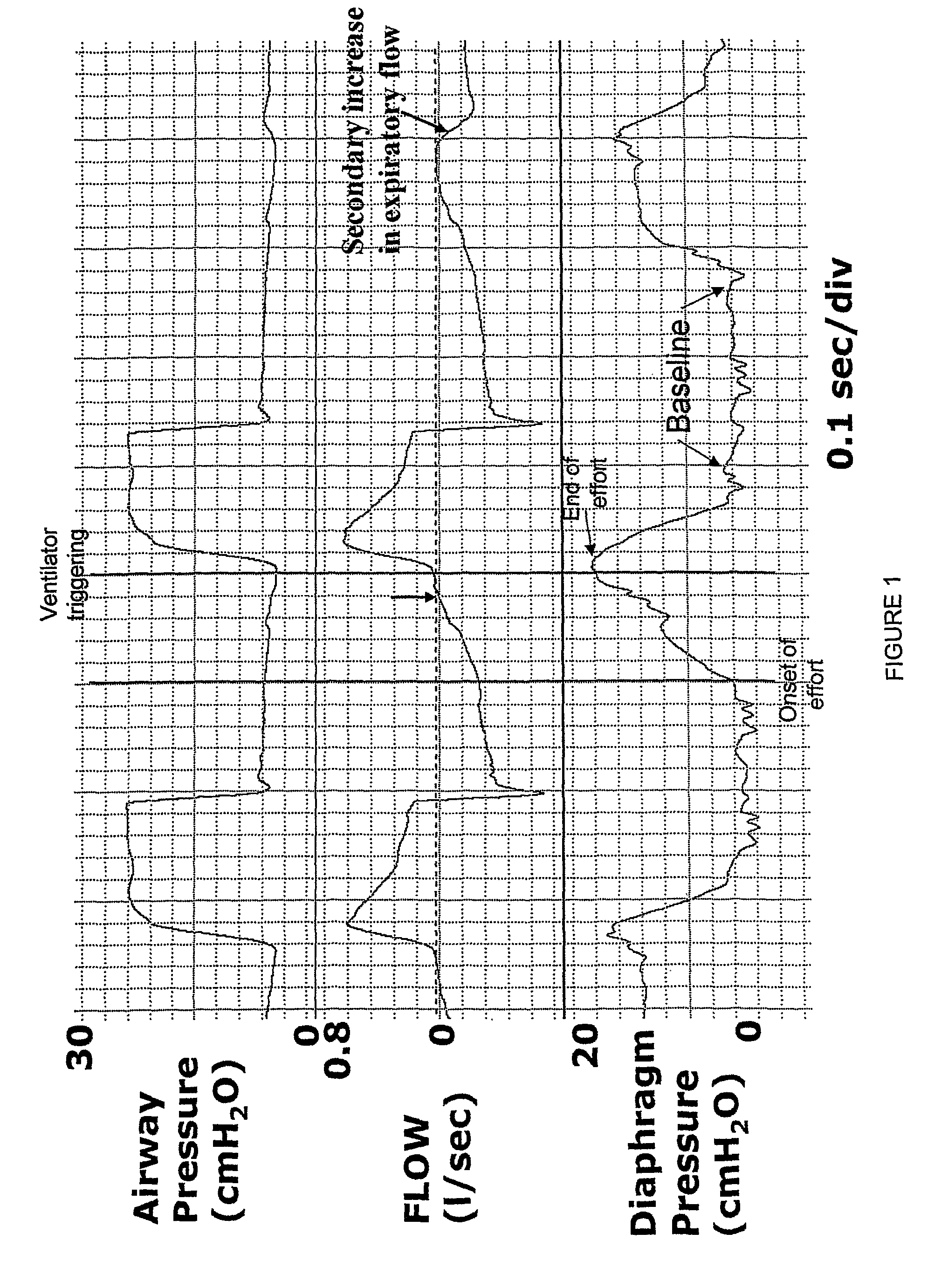Method and device for generating of a signal that reflects respiratory efforts in patients on ventilatory support