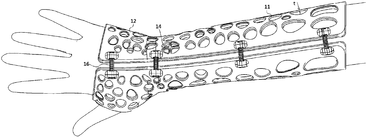 Adjustable outer fixing support and its material formula, preparation method and use method