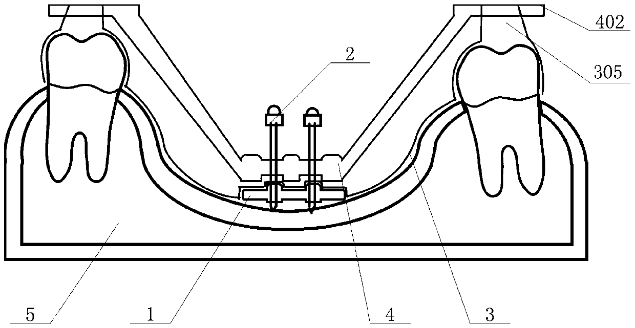 Corrector for correcting maxillary skeletal width disorder