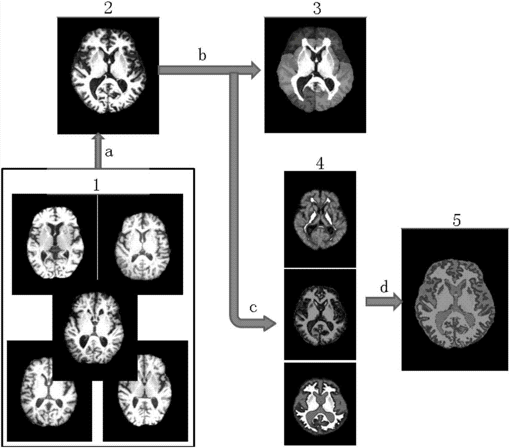 Quantitative calculation method for automatic regional brain shrinkage degree