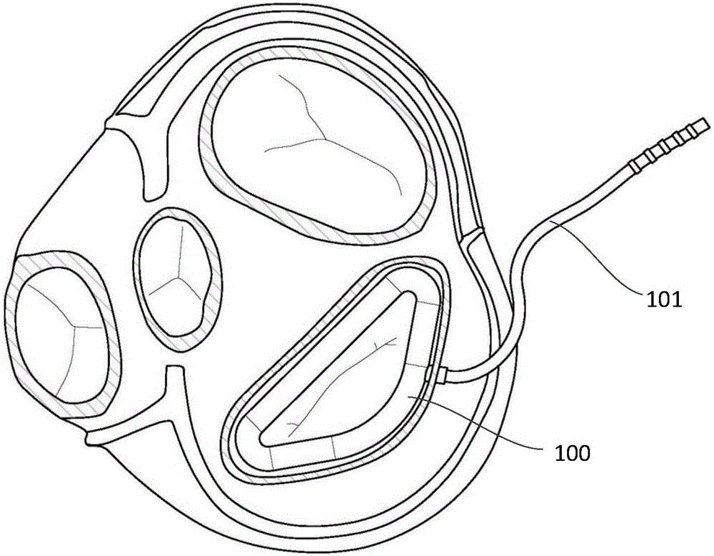 Mitral valve forming ring
