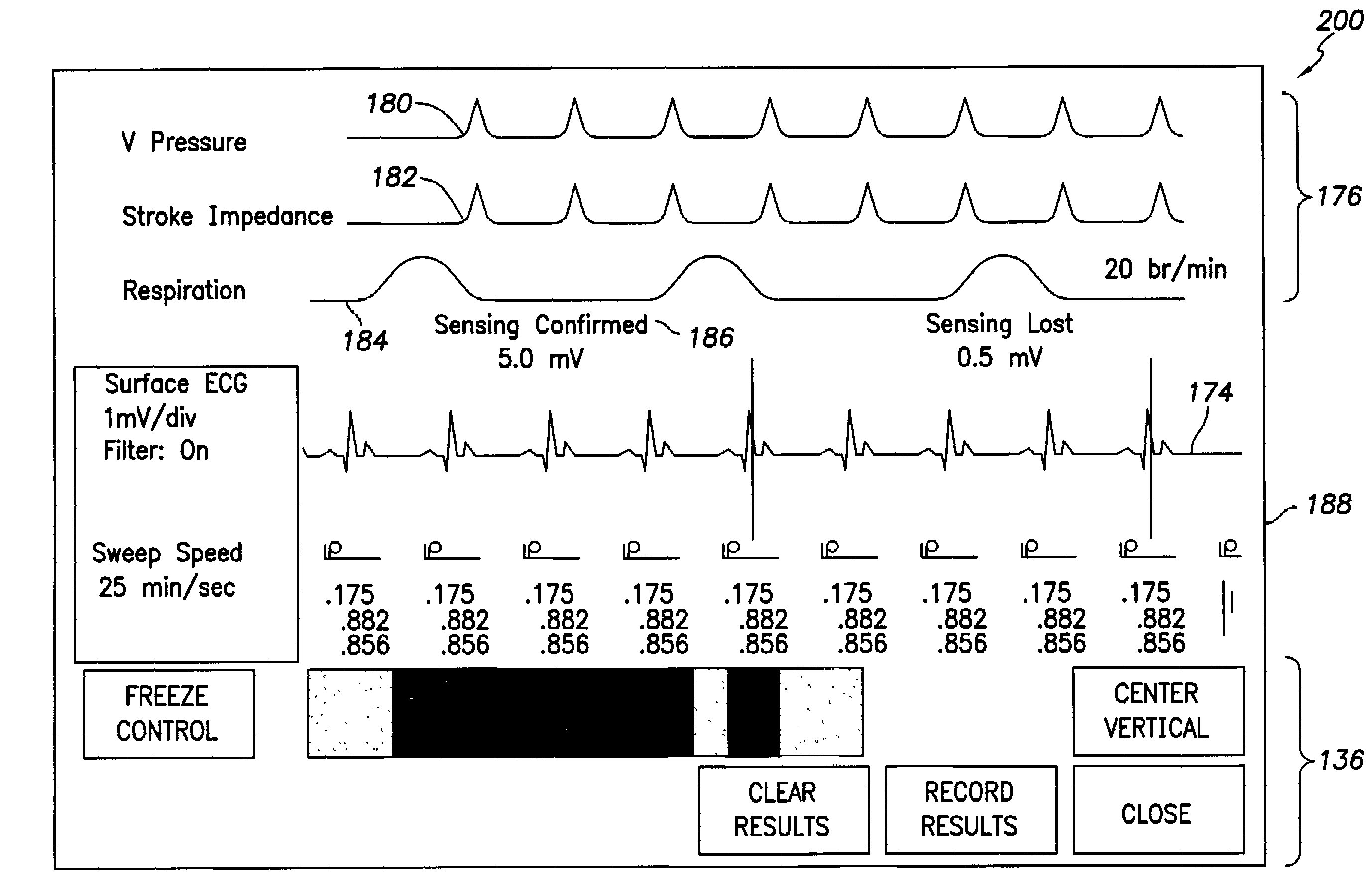 Physician programmer system with telemetered sensor waveform
