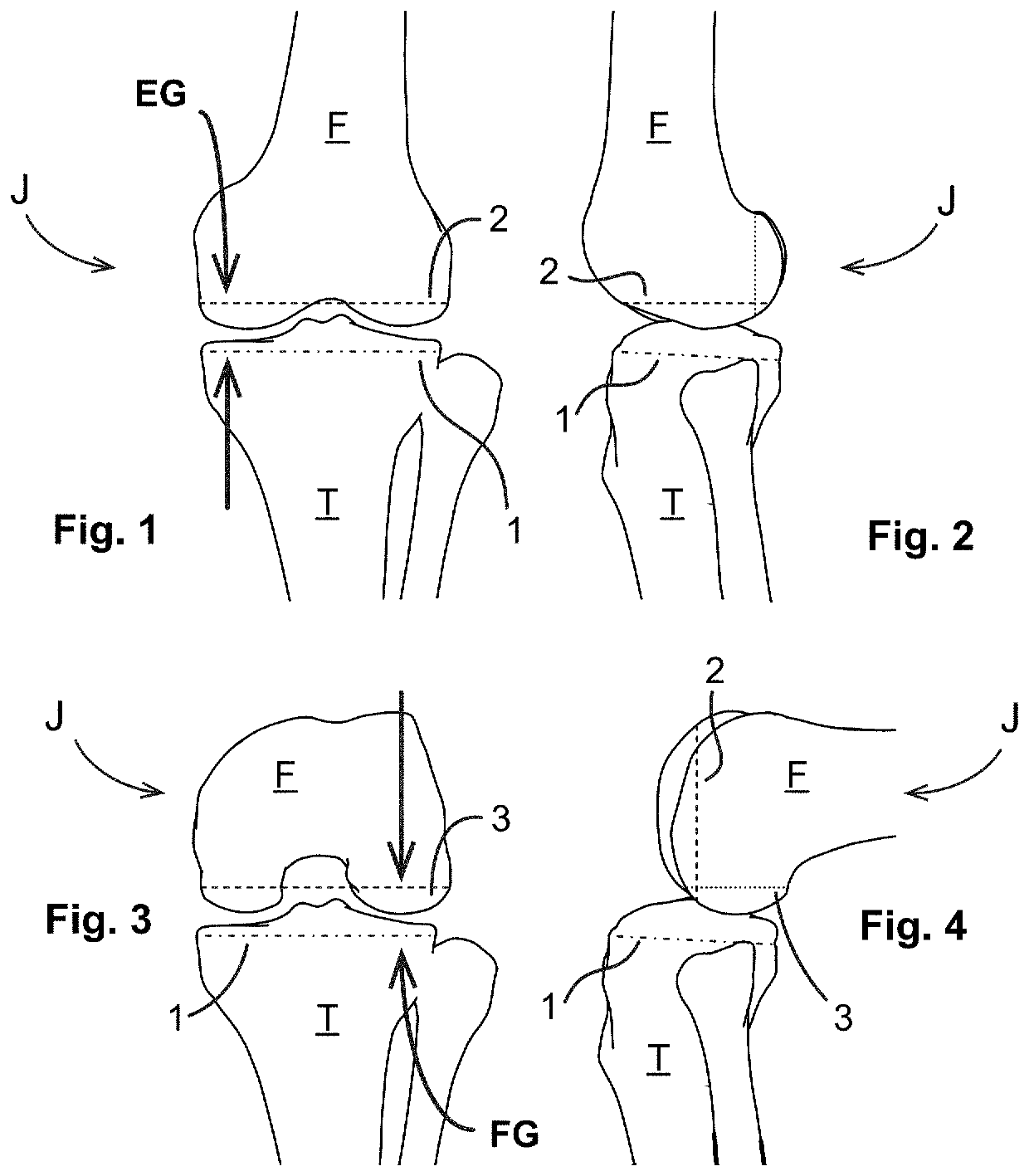 Knee flexion and extension gap tensioning and measuring method