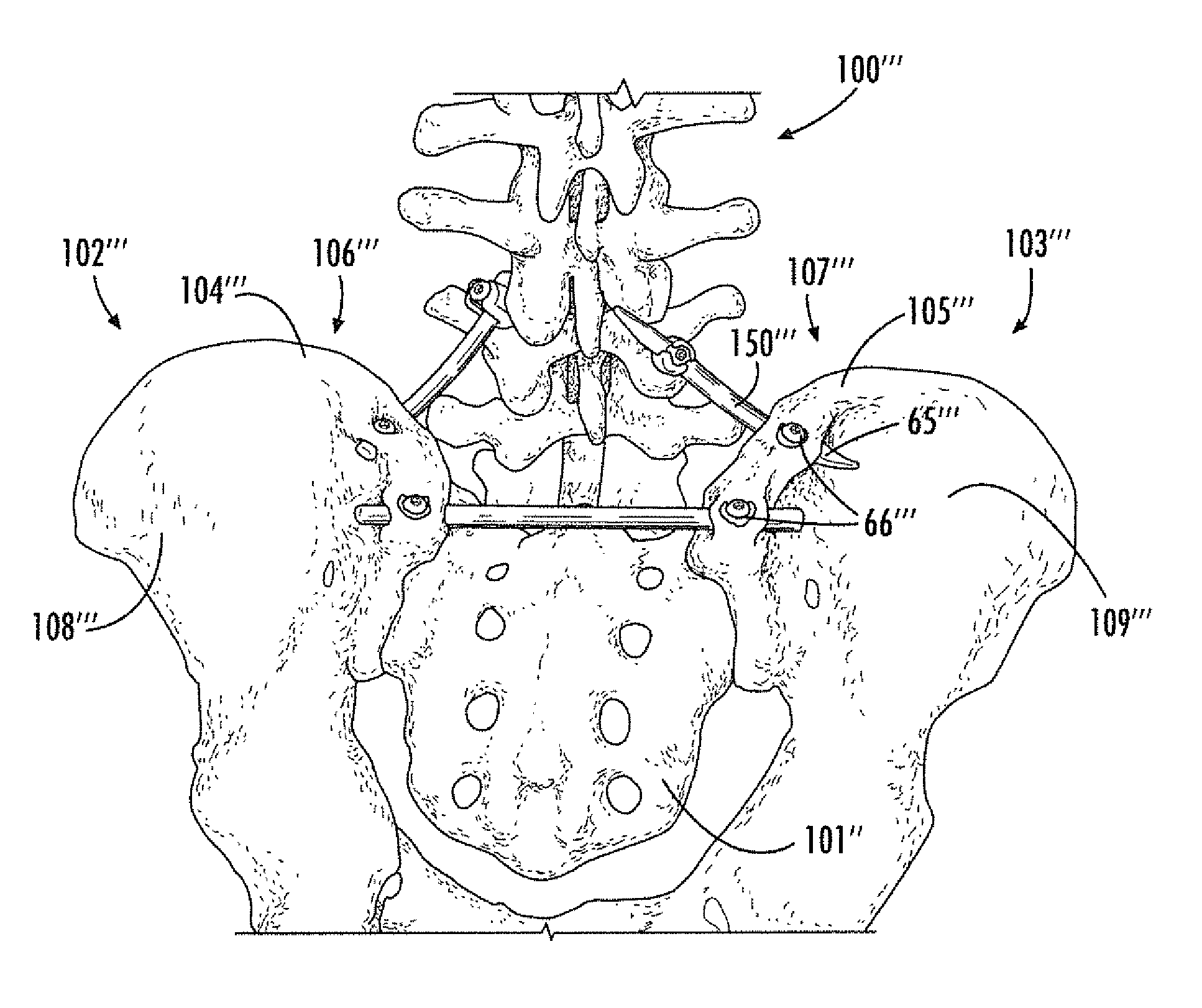 Surgical devices and methods providing sacroiliac stabilization