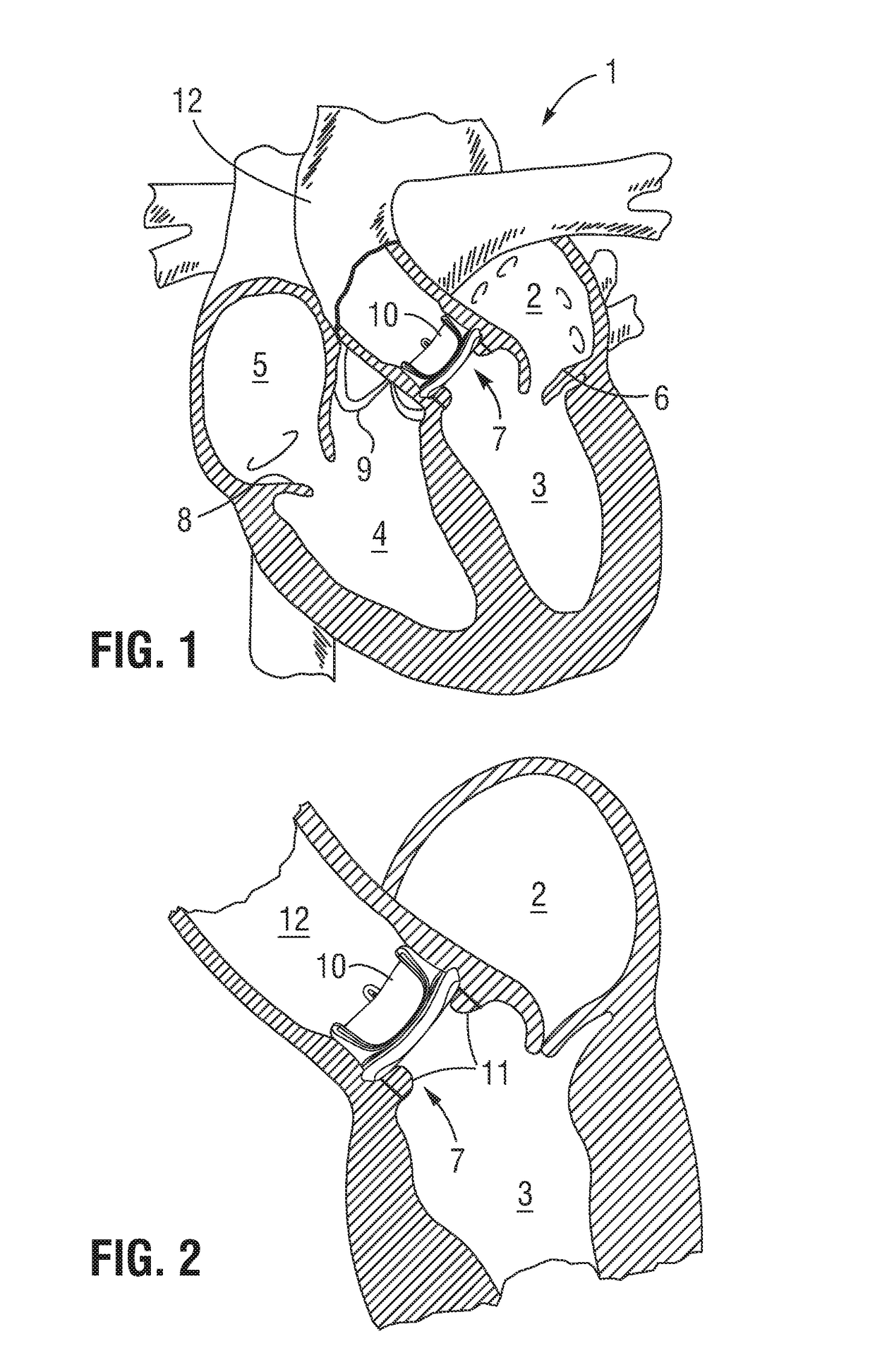 Valve implant with integrated sensor and transmitter