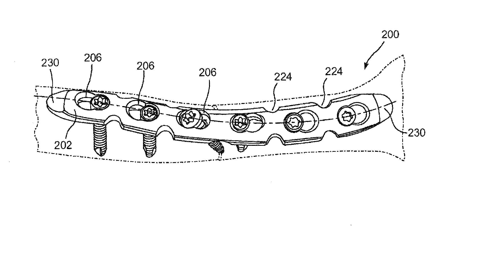 System and Method for Minimally Invasive Clavicle Plate Application