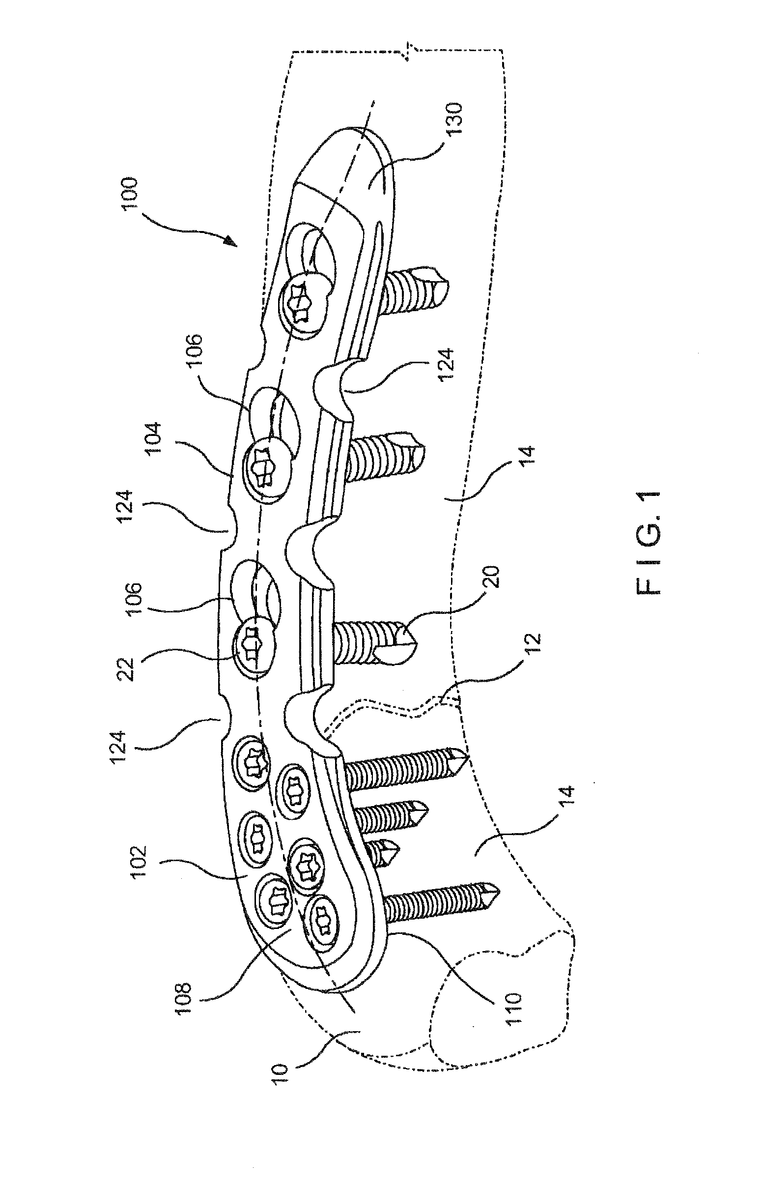 System and Method for Minimally Invasive Clavicle Plate Application