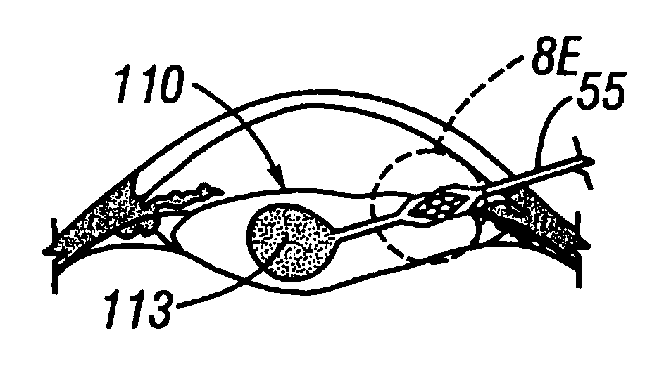 Method of crystalline lens replacement