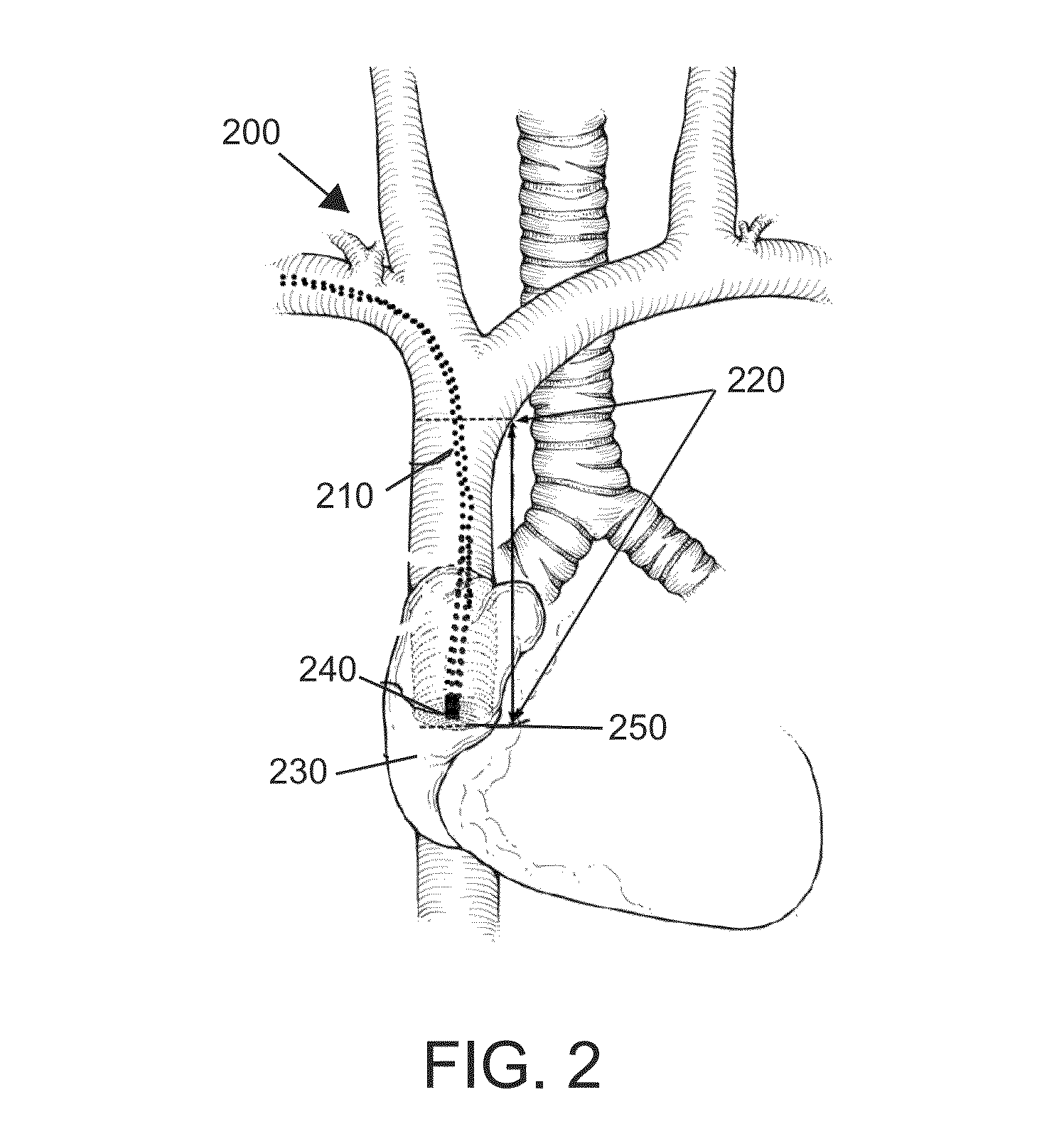 Method and system of utilizing ECG signal for central venous catheter tip positioning