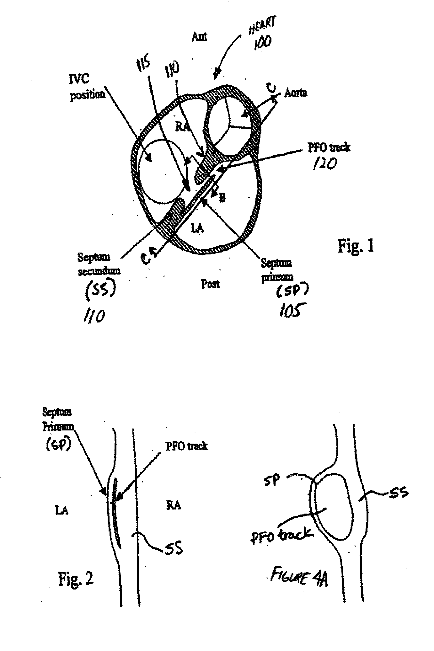 Patent foramen ovale closure method