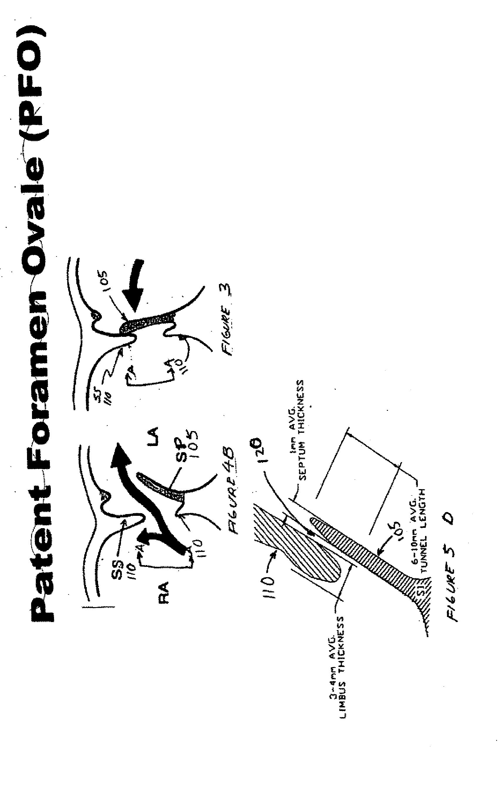 Patent foramen ovale closure method