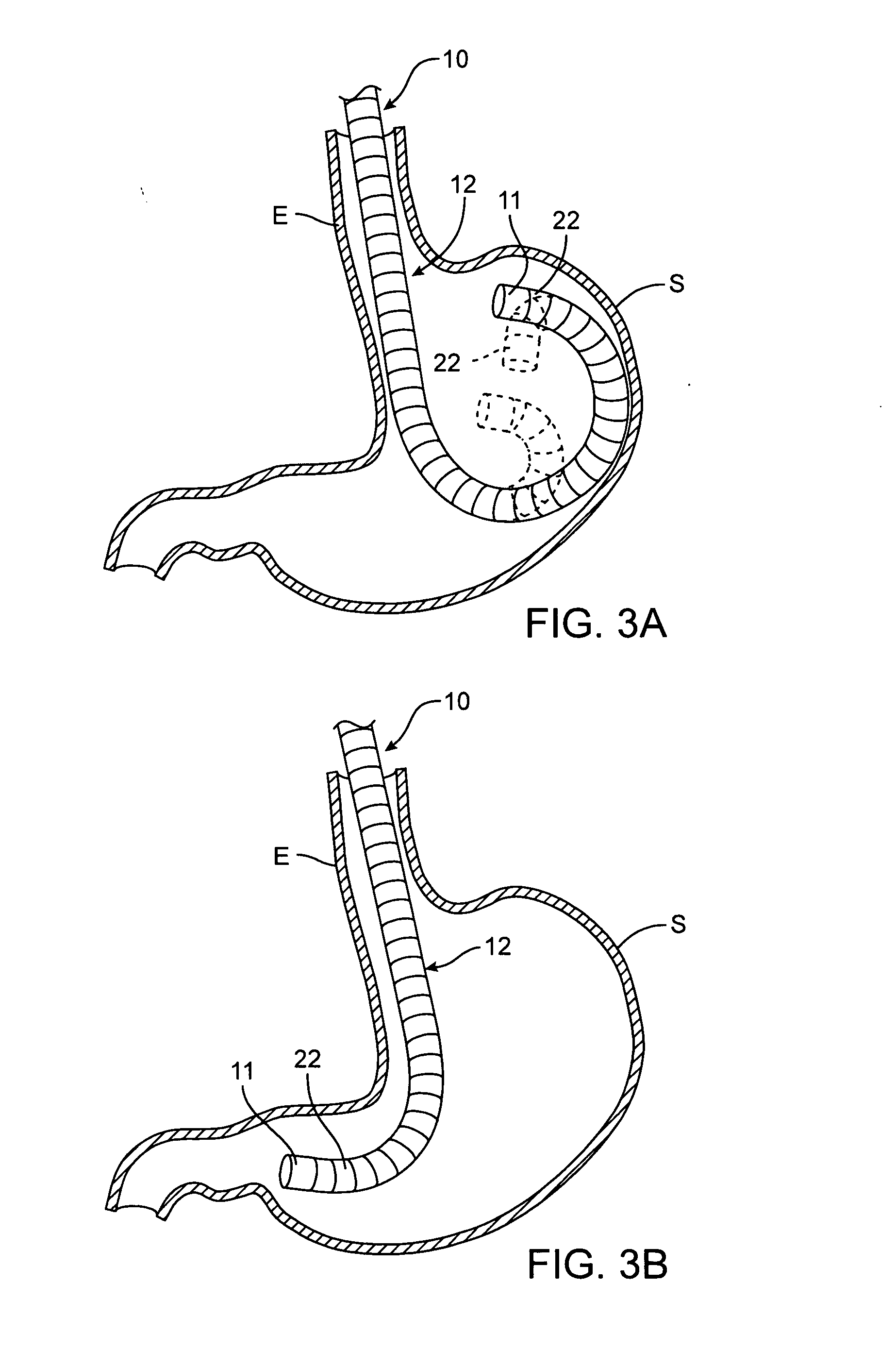 Apparatus and methods for obtaining endoluminal access with a steerable guide having a variable pivot