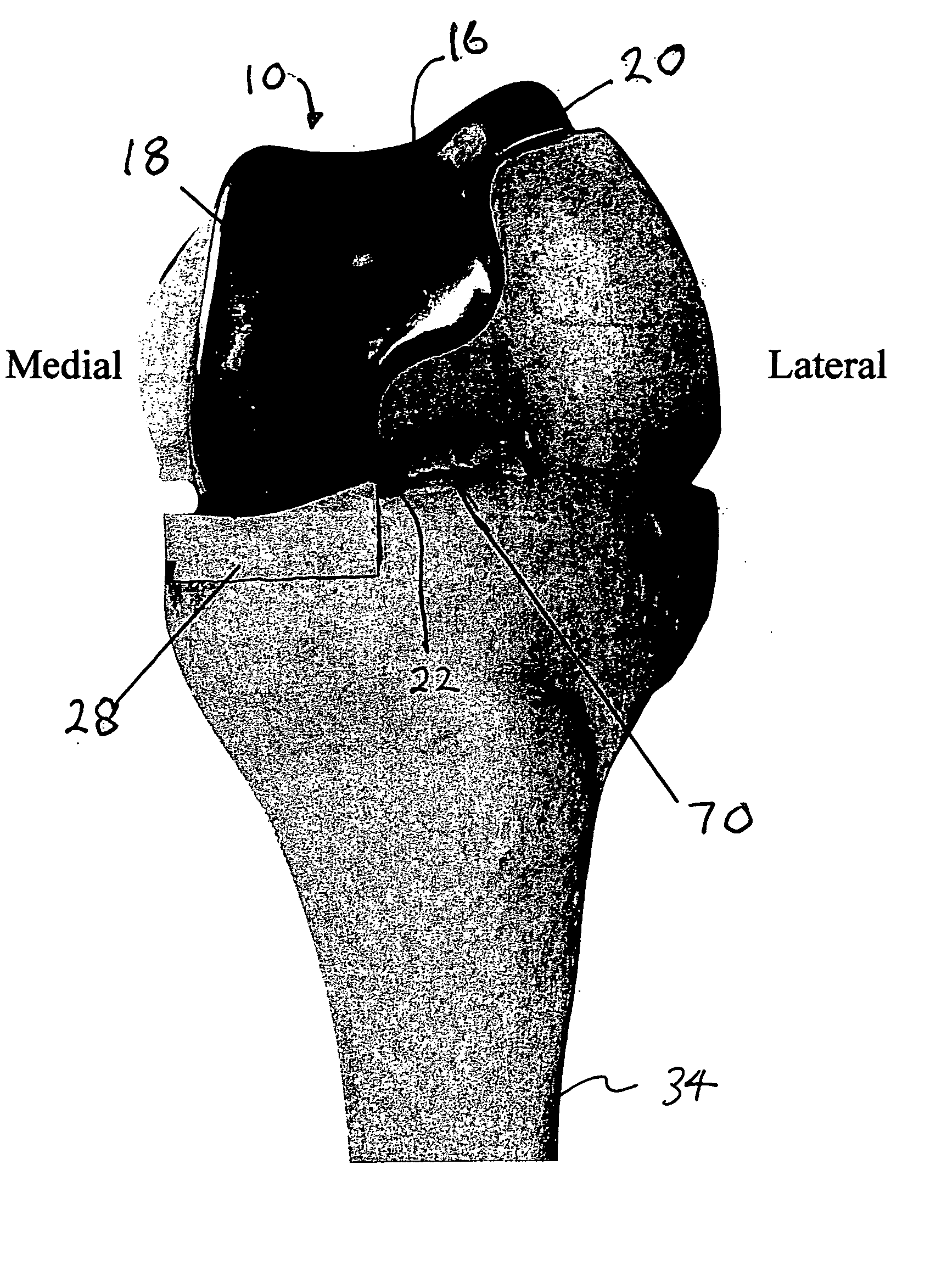 Device and method for bicompartmental arthroplasty