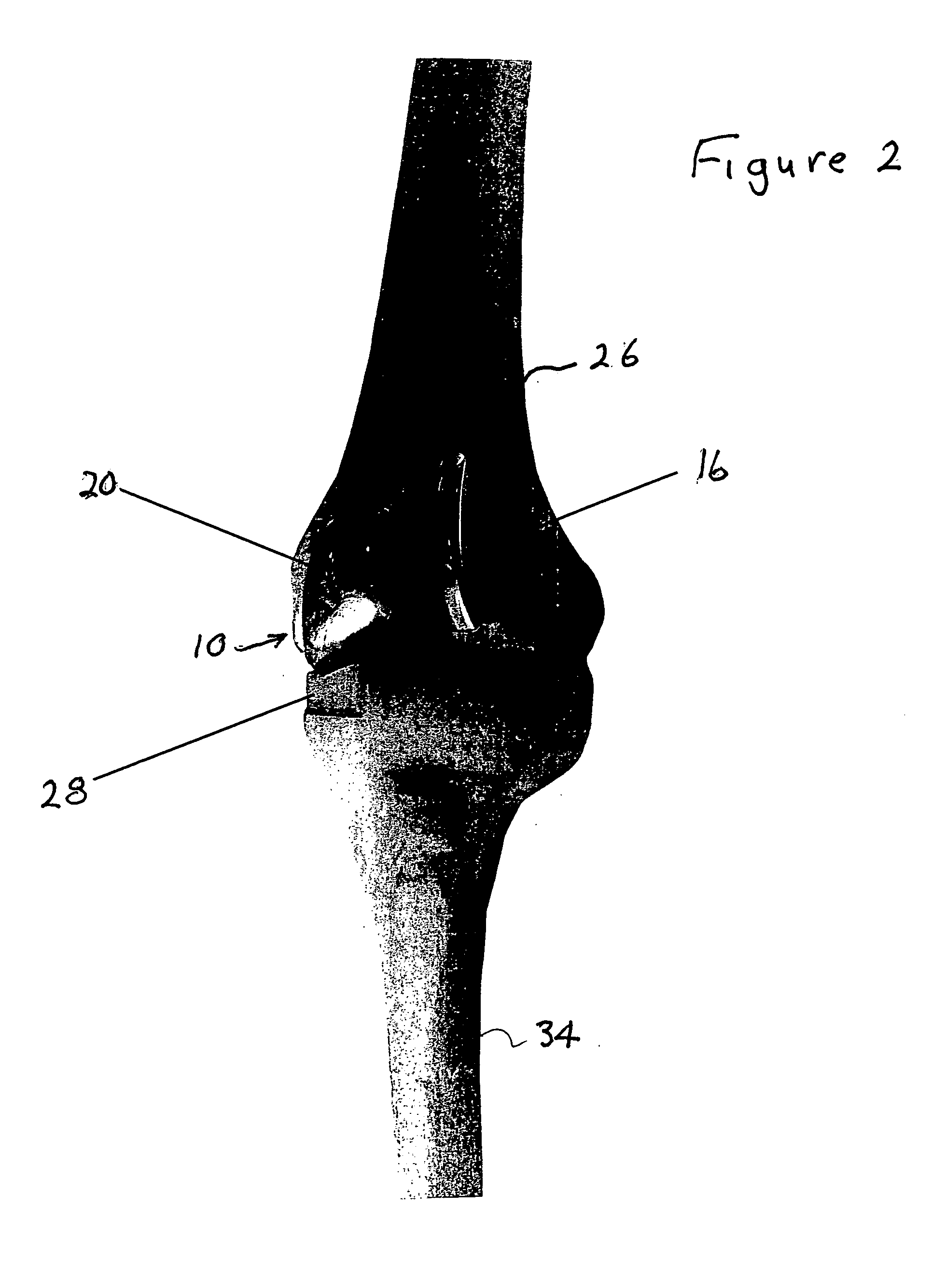 Device and method for bicompartmental arthroplasty