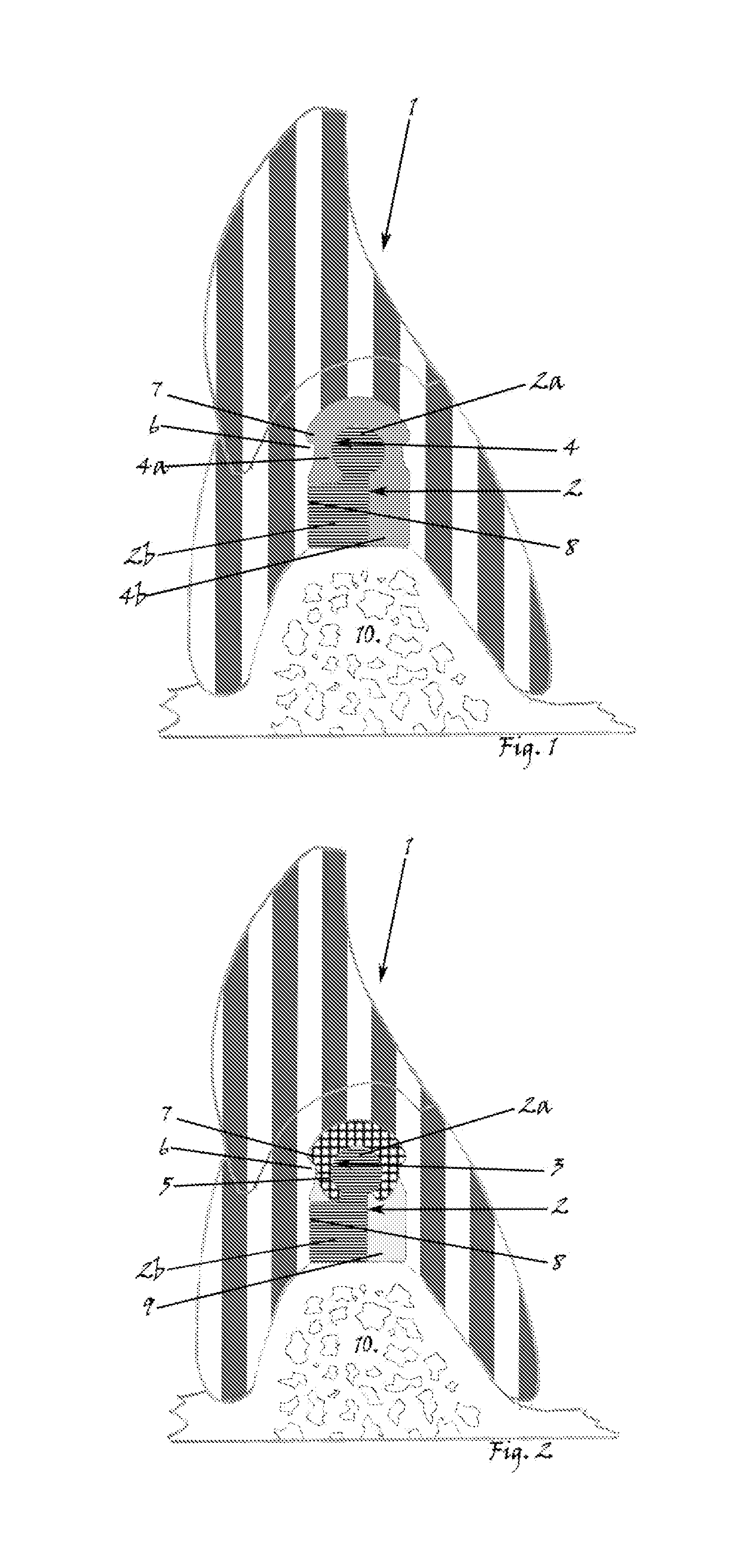 Precision attachment system with indirect retainer