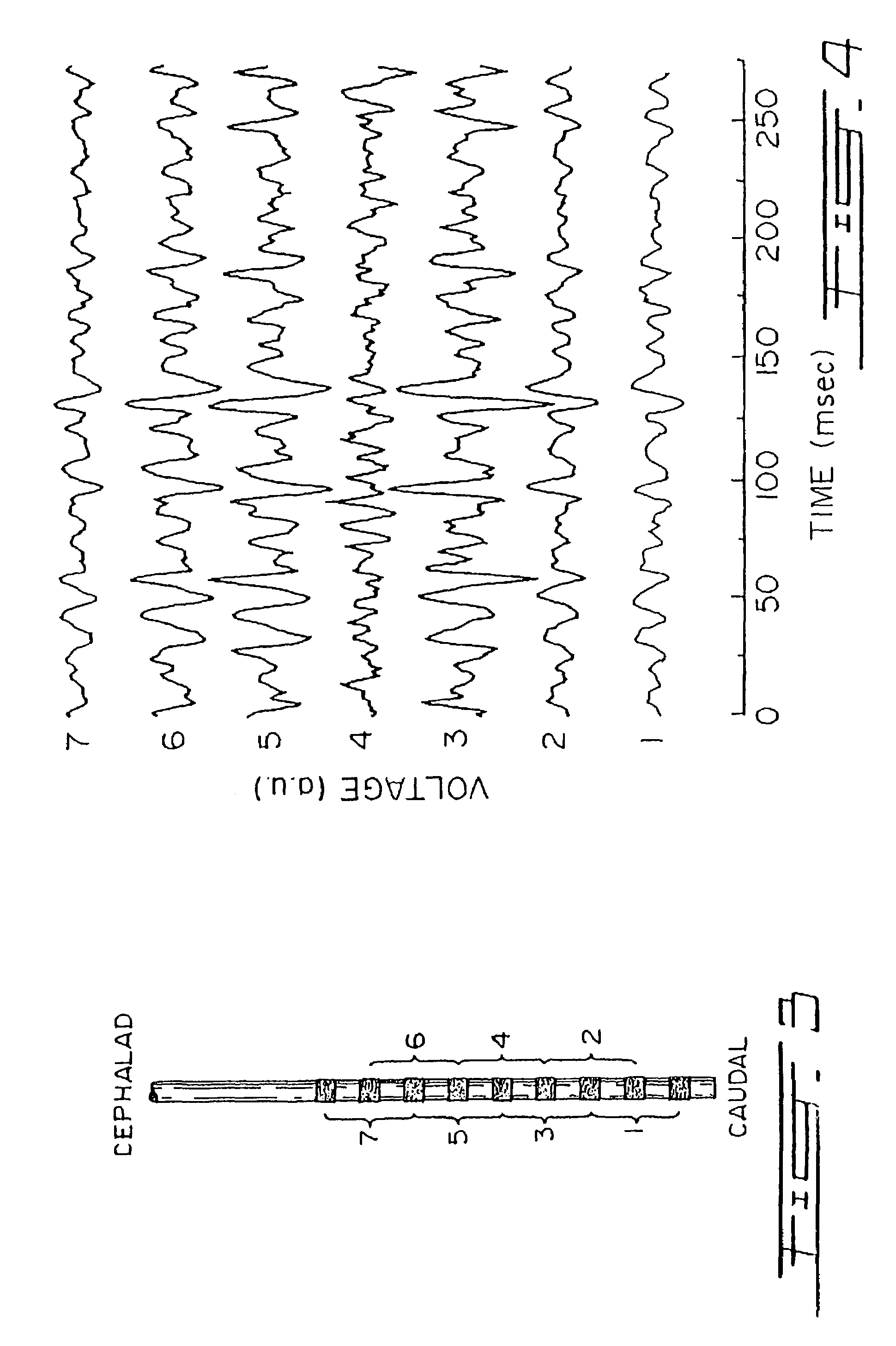 Proportional pressure assist ventilation controlled by a diaphragm electromyographic signal