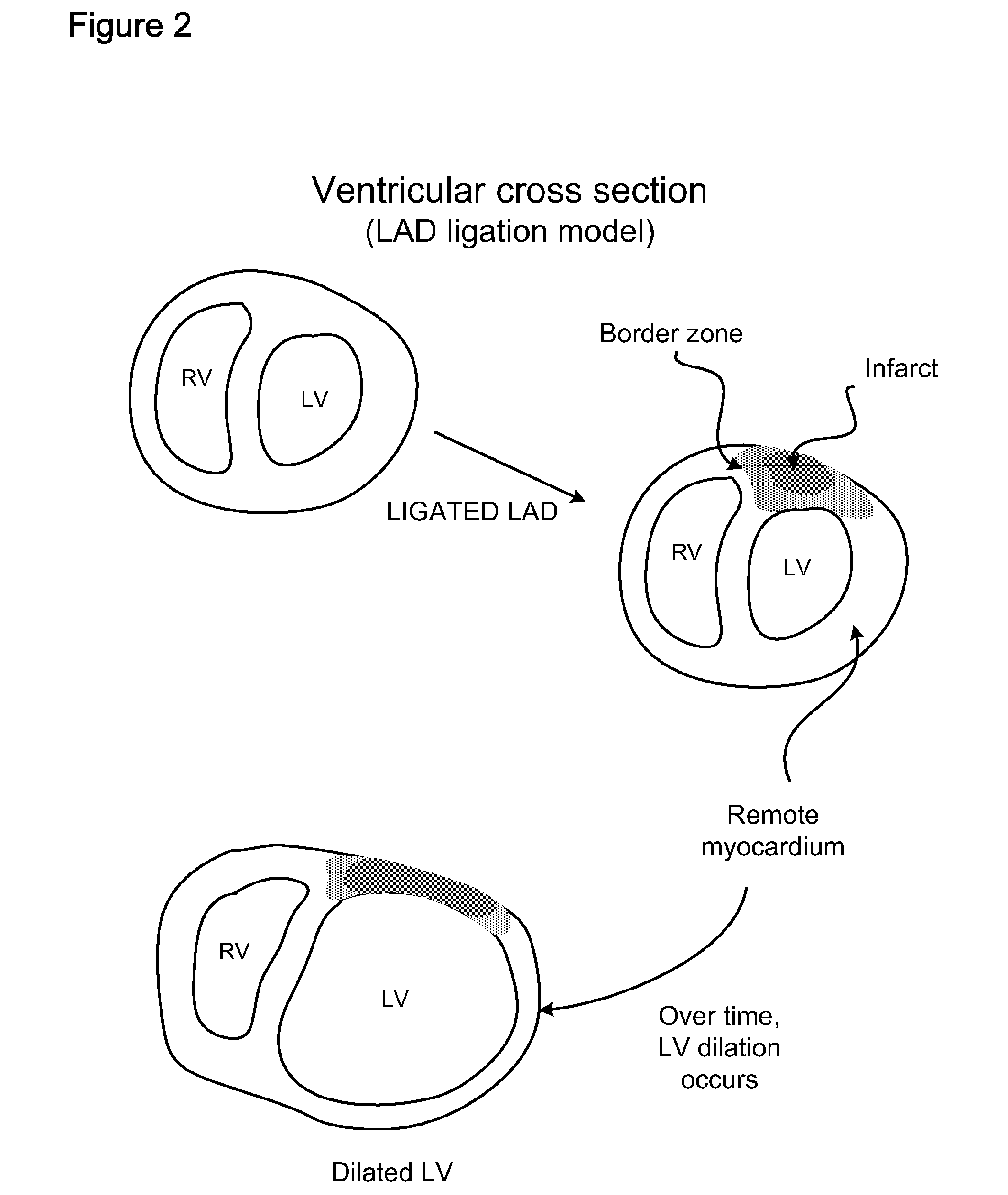 Methods and compositions for inhibiting progression to chronic cardiac failure