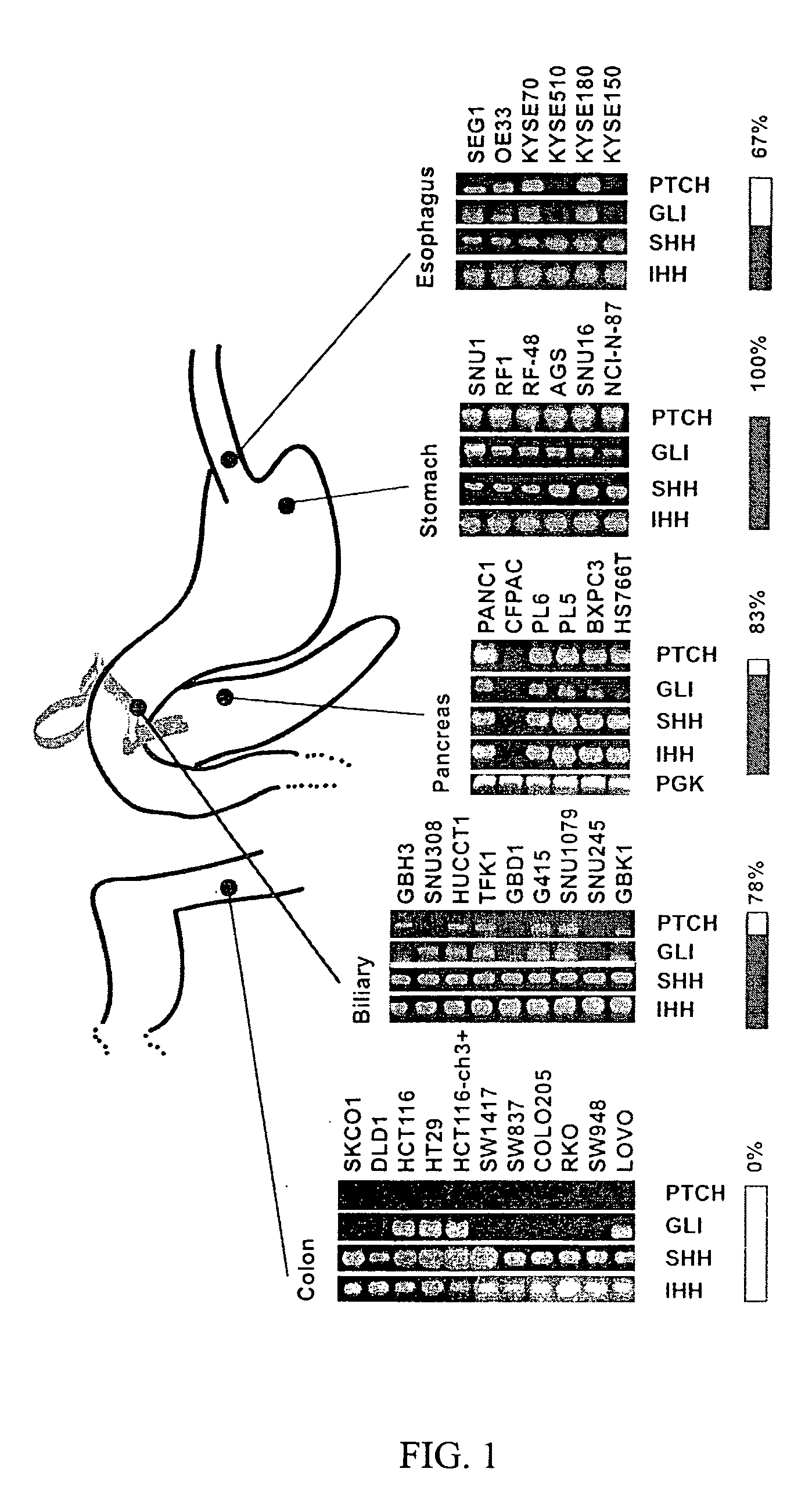 Elevated Hedgehog Pathway Activity In Digestive System Tumors, And Methods Of Treating Digestive Sytem Tumors Having Elevated Hedgehog Pathway Activity