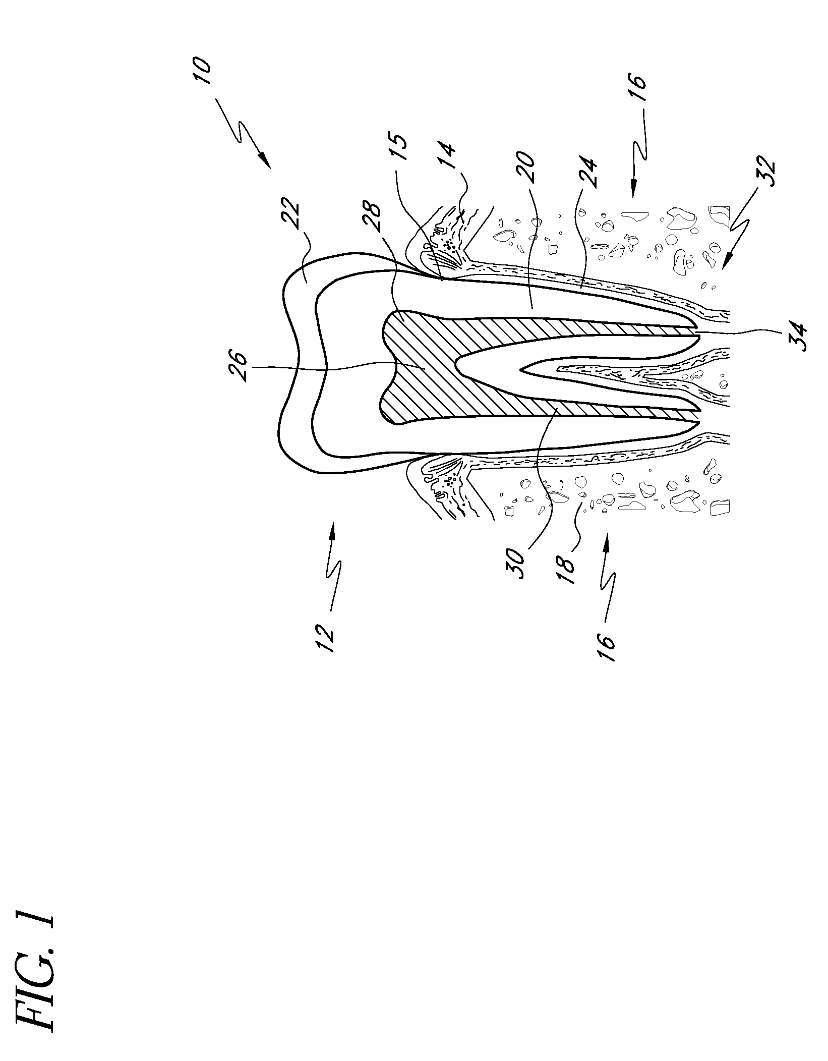 Apparatus and methods for treating root canals of teeth
