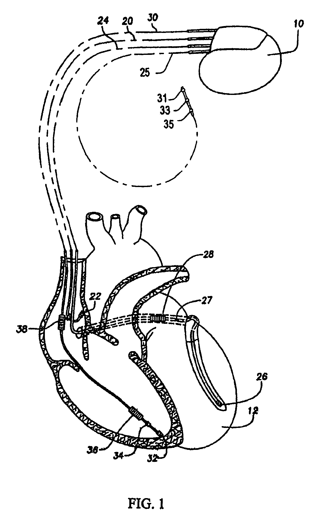 Pacing schemes for revealing T-wave alternans (TWA) at low to moderate heart rates