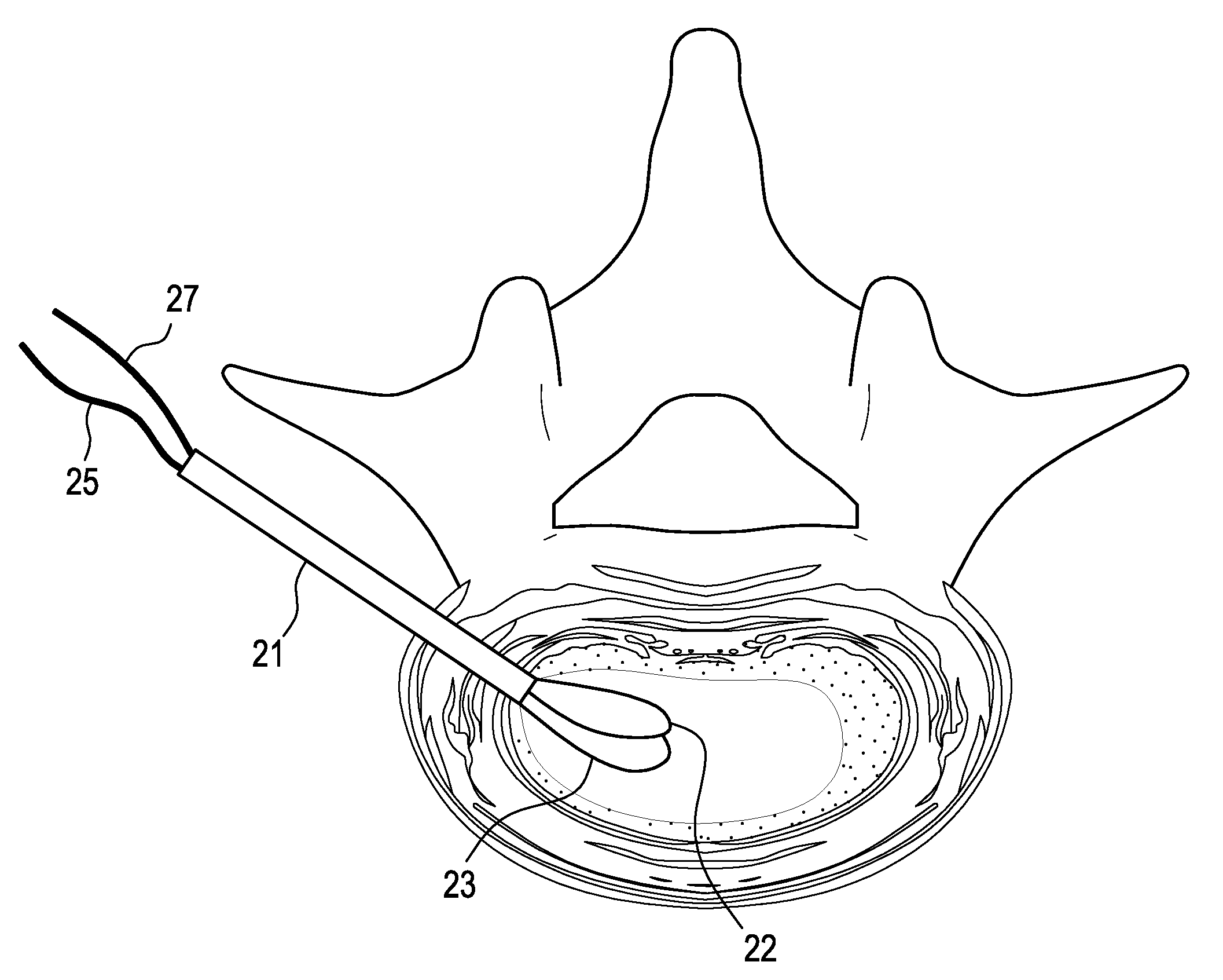 Nucleus replacement device and method