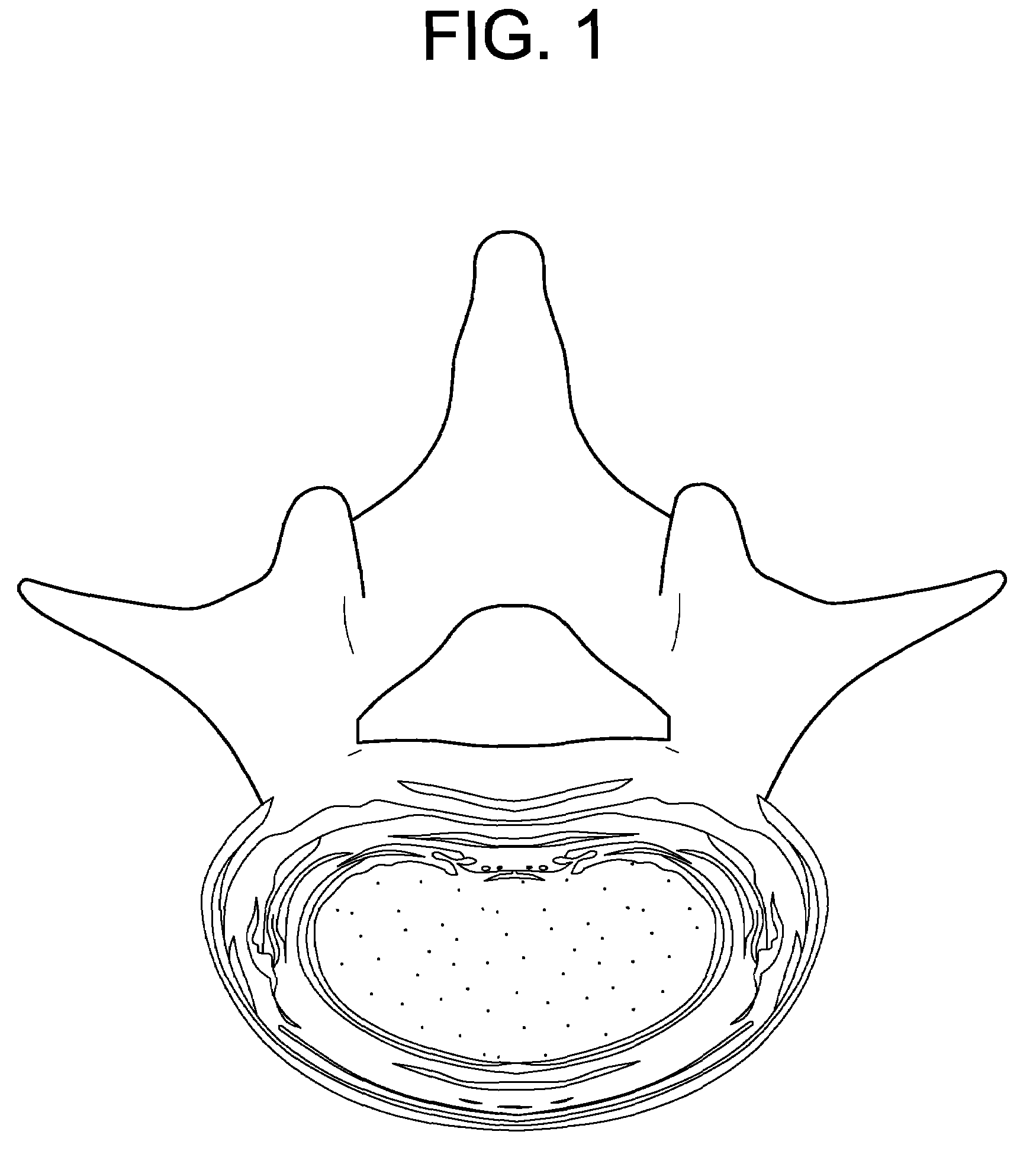 Nucleus replacement device and method