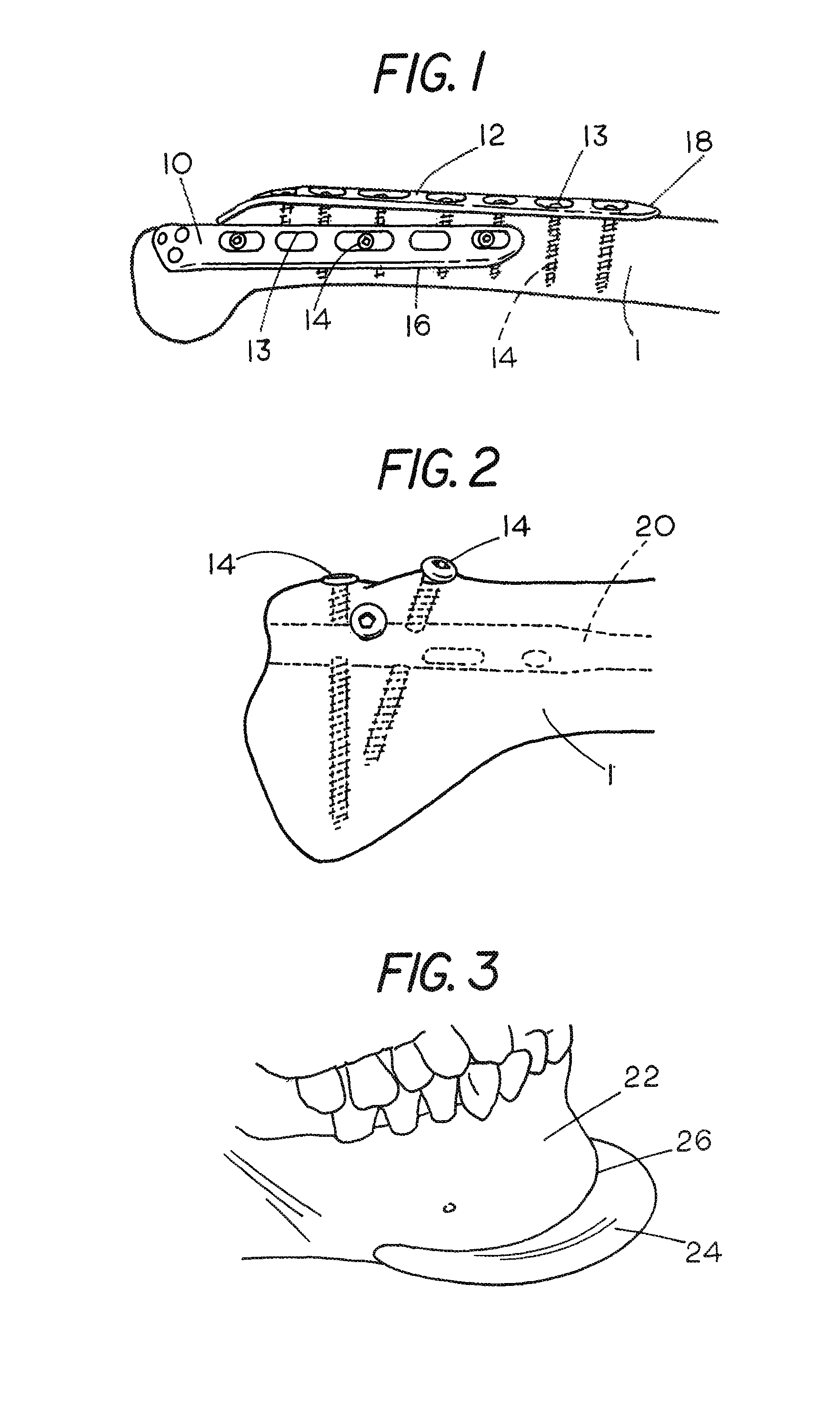 Moldable cushion for implants
