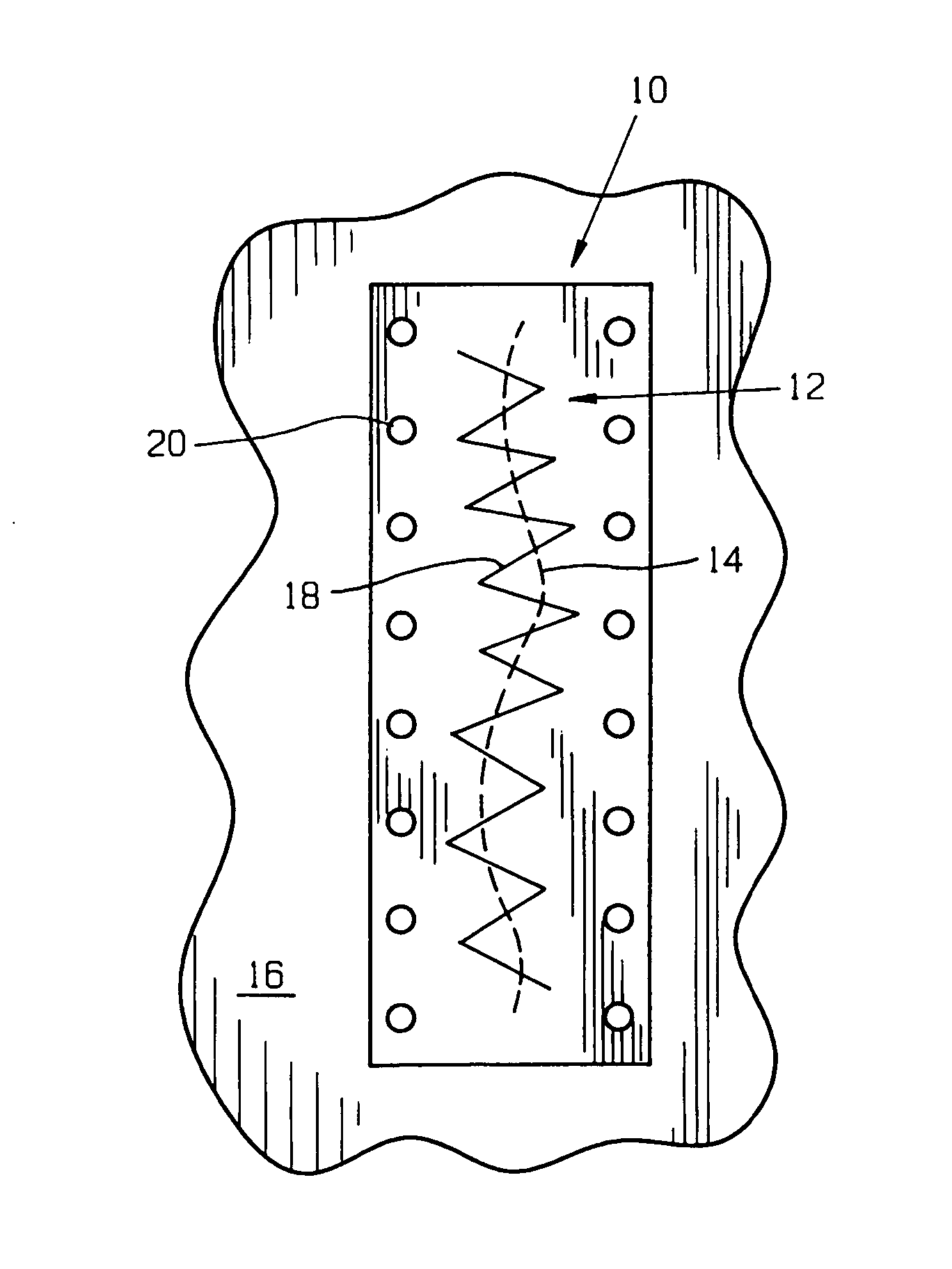 Surgical method and composition utilizing submucosal tissue to prevent incisional hernias