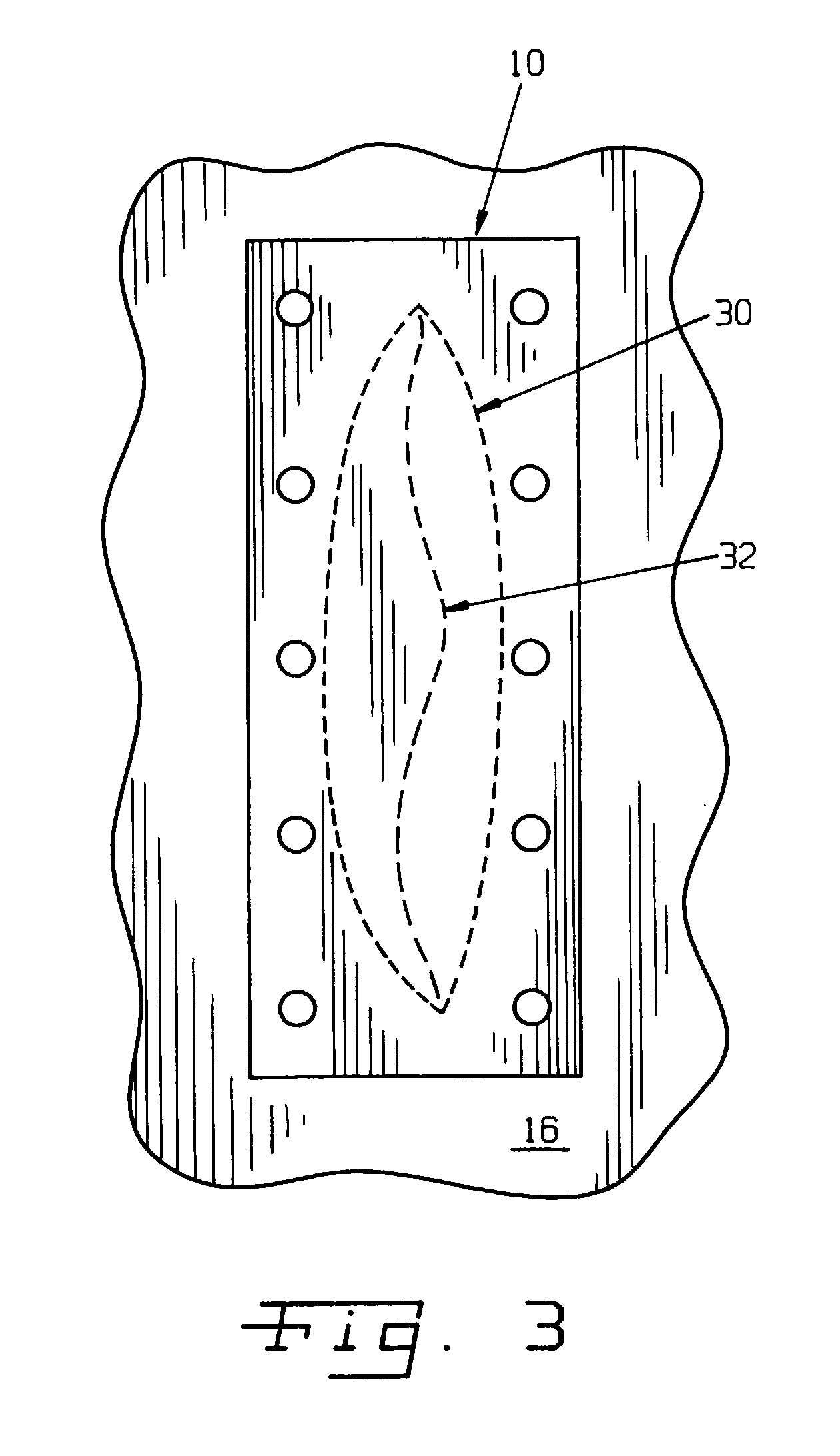 Surgical method and composition utilizing submucosal tissue to prevent incisional hernias