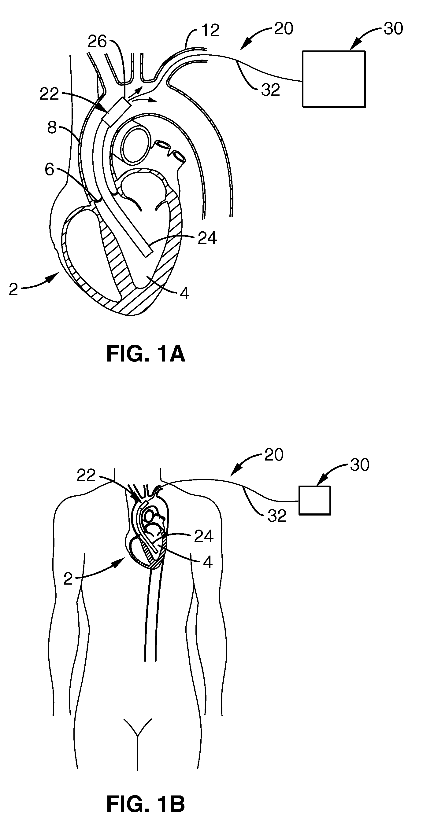 Heart assist device