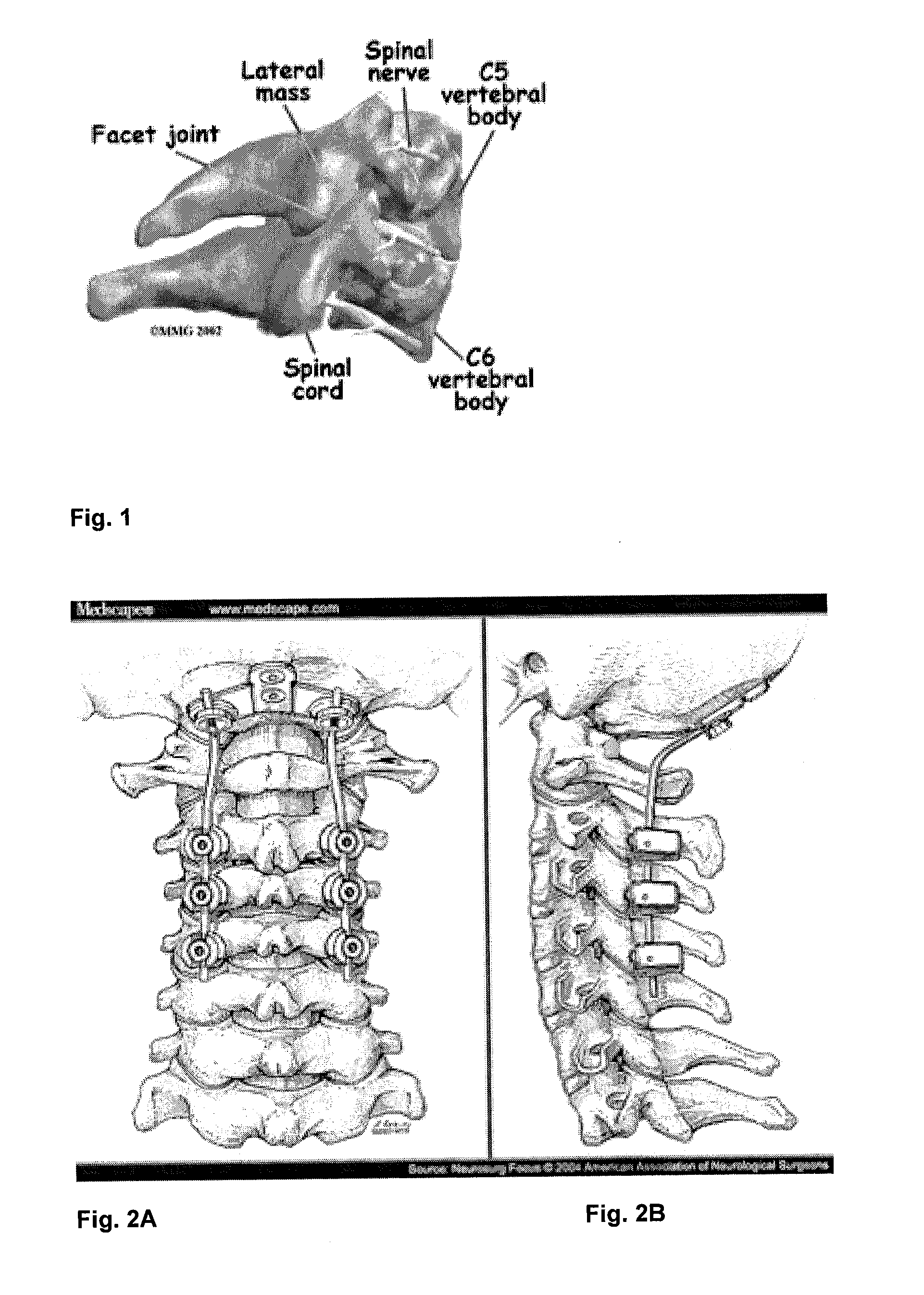 Lateral mass fixation system