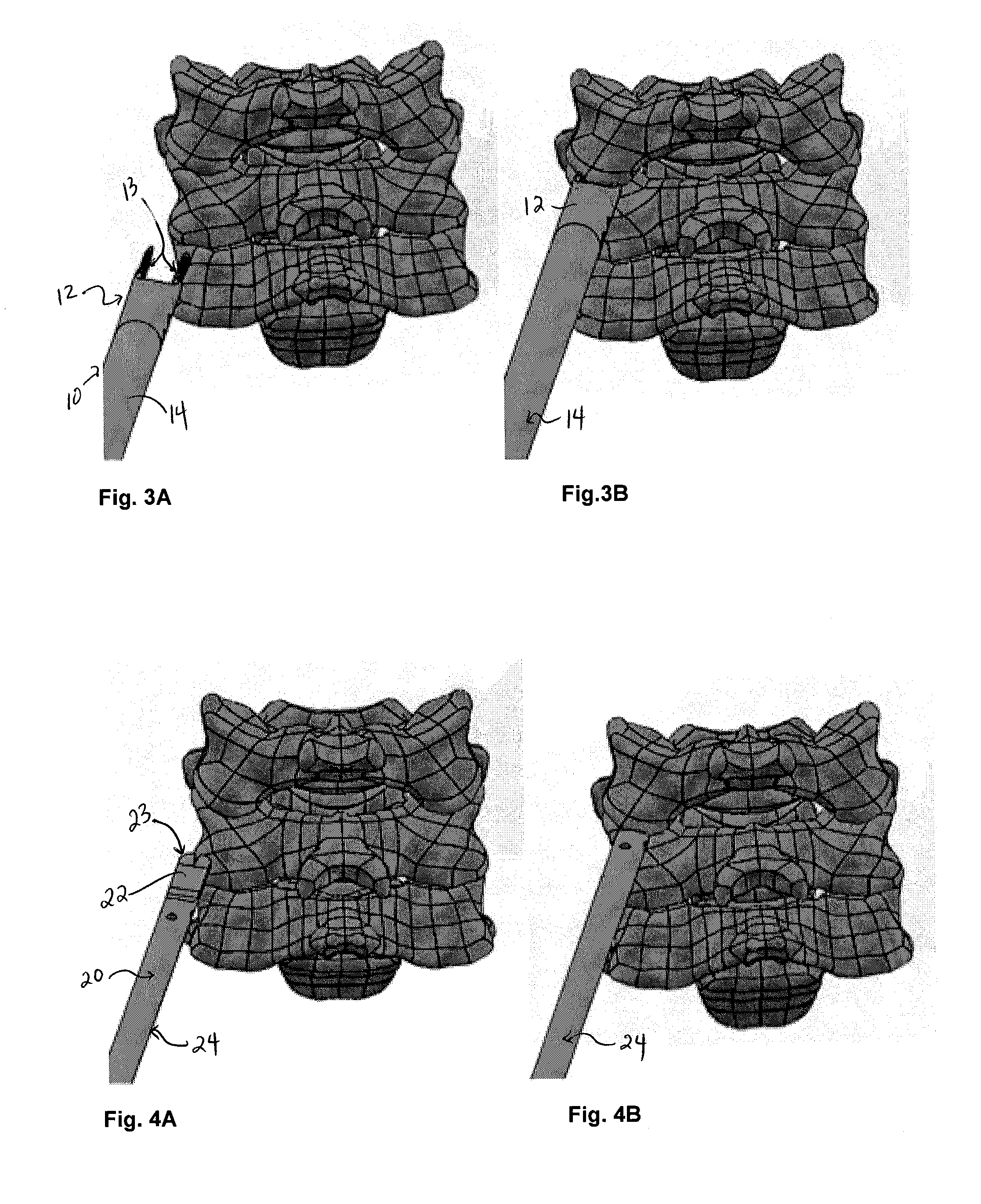 Lateral mass fixation system