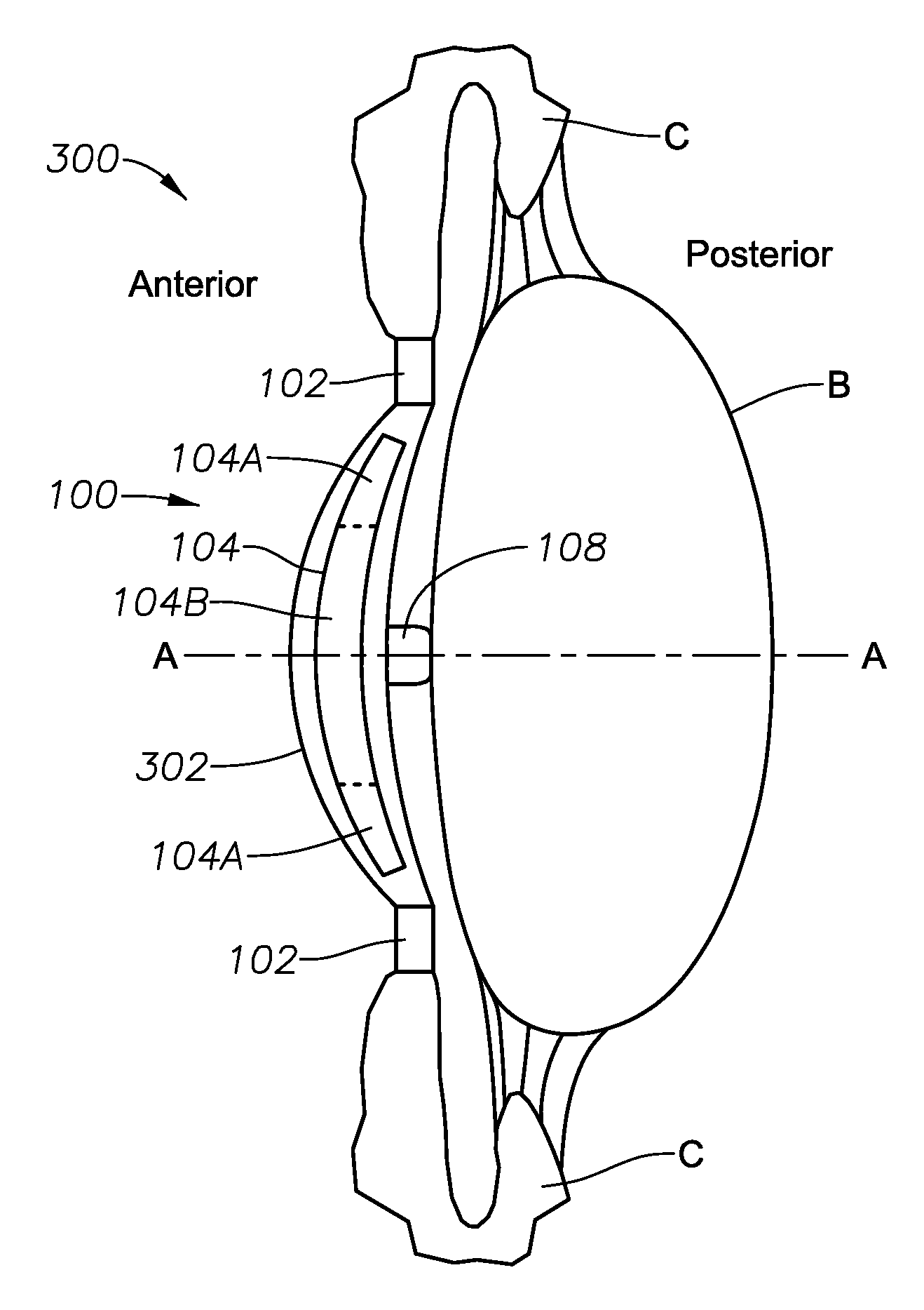 Accommodating intraocular lens with ciliary body activation